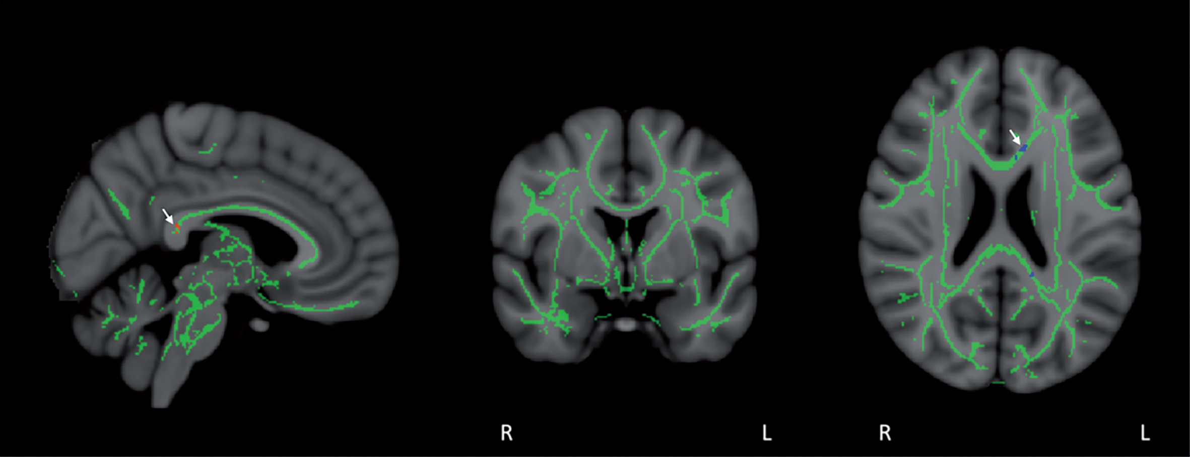 Co-registration of DTI-derived fractional anisotropy (FA) images via tract-based spatial statistics (TBSS) resulted in a skeleton containing all major FA tracts common to all eight subjects, as shown in mid-sagittal, coronal, and horizontal sections. FA values were then compared in a voxel-by-voxel analysis for group differences between Baseline and Day60 (end of treatment). FA stability was evident during the treatment period, with only a small group of voxels in the posterior cingulate/cingulate and corpus callosum (arrows) exhibiting significant FA enhancement (red voxels) or FA reduction (blue voxels) for all eight subjects collectively (p < 0.05).