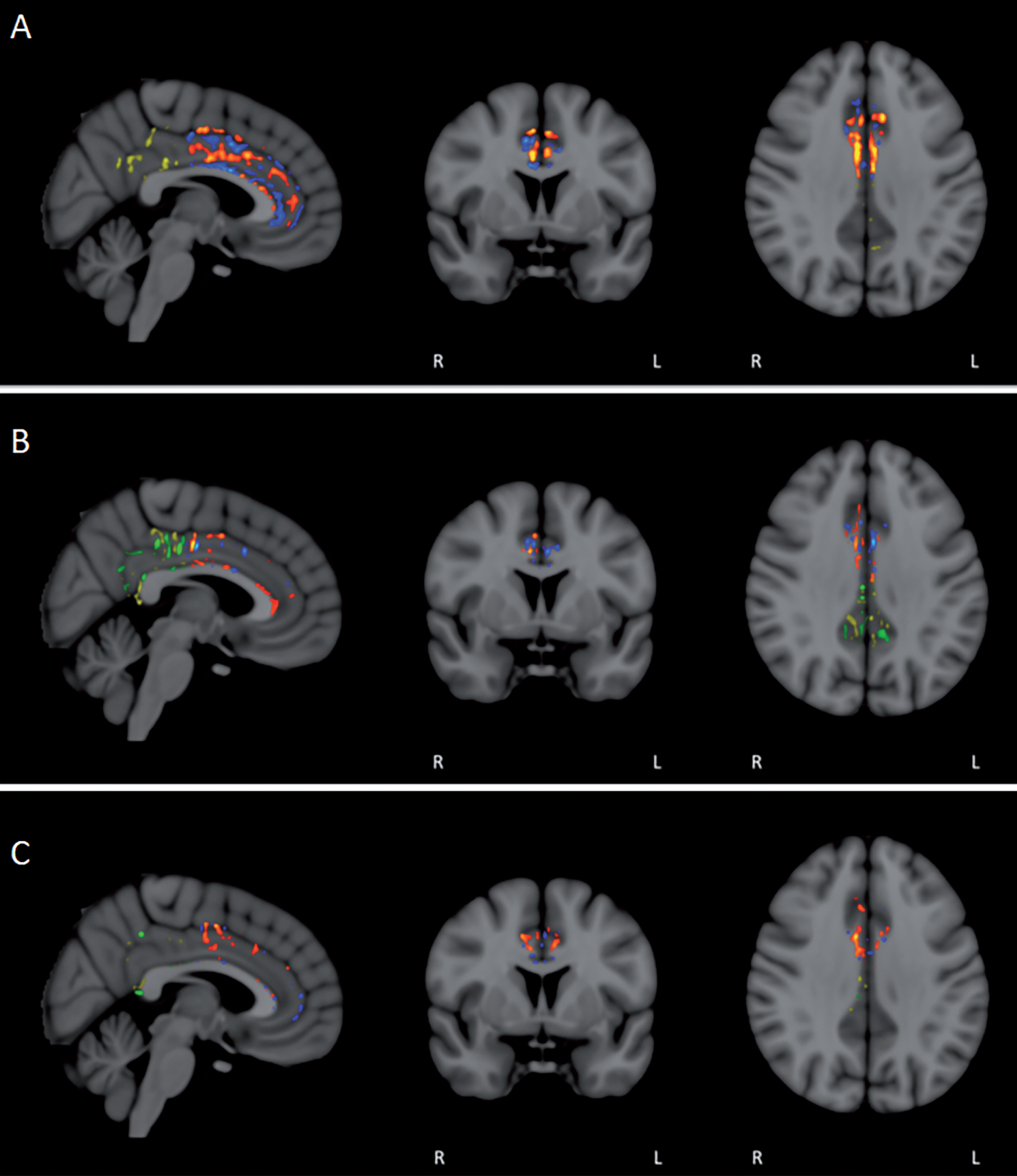 FA/DTI analysis in individual subjects for pre- versus post-treatment differences in the anterior and posterior cingulate cortex/cingulum. Voxel-by-voxel analysis for significant differences (p < 0.05) revealed not only the expected areas of decreased FA in individual subjects (blue/green in anterior/posterior), but also prominent area of enhanced FA (red/yellow in anterior/posterior). For most subjects, enhanced FA was observed in both the anterior and posterior cingulate cortex/cingulum (A and B), although several subjects exhibited more pronounced FA enhancement in either the anterior (C) or posterior regions.