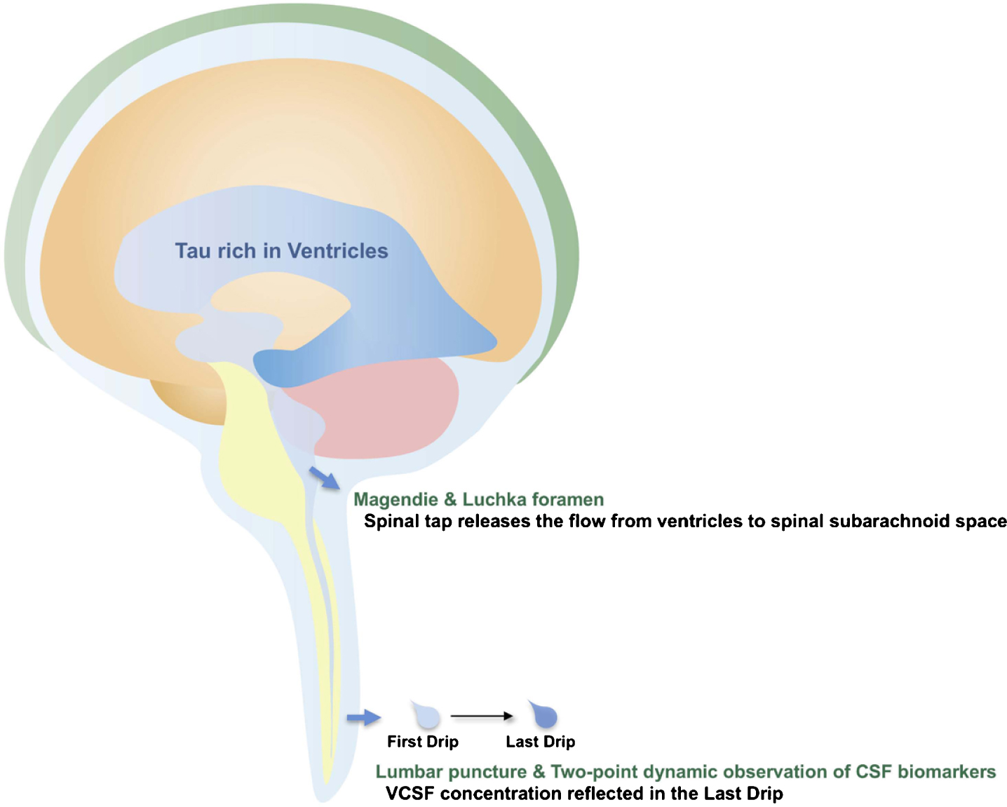 Schematic depiction of presumed CSF flow and tau passage during the tap test. Spinal tap releases a flow of CSF from ventricles to spinal subarachnoid space. In consequence, high concentration of tau in VCSF is reflected in the Last Drip.