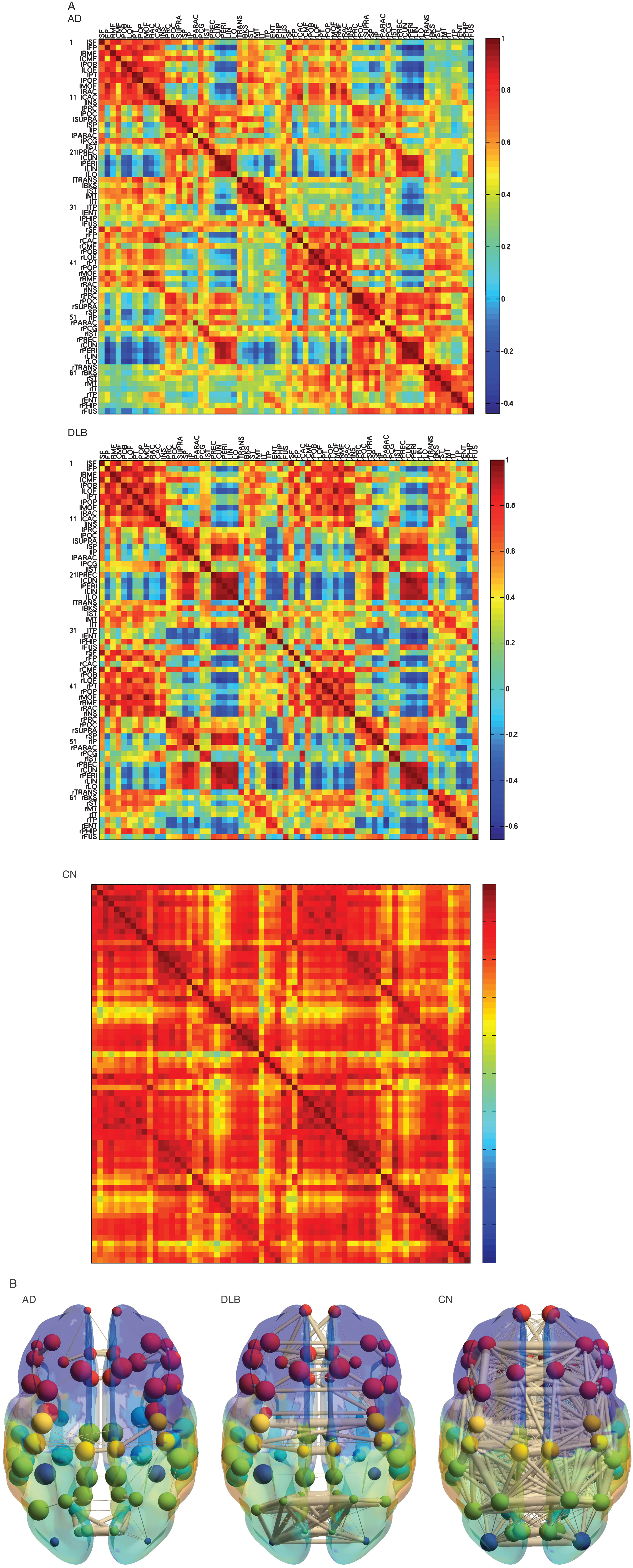 Metabolic connectivity matrix and anatomical localizations. A) Metabolic connectivity matrix. The cell color in the correlation matrix indicates the magnitude of the correlation, and the color is arranged in gradation from red to blue in accordance with the magnitude of correlation from positive to negative. Note that the lower limit of the correlation range is different in each matrix (See a color navigation side bar). Some of the correlations decreased more severely in DLB than in AD. In addition, other correlations in DLB are relatively preserved. The texture of the matrix in DLB looks “patchy” compared with that in AD. AD, Alzheimer’s disease; DLB, dementia with Lewy bodies; CN, cognitive normal. B) The 3D schematic figures representing metabolic connectivity. The metabolic connections are overlaid on an anatomical atlas using nodes and edges. These figures are used to display an outline of the whole connectivity.