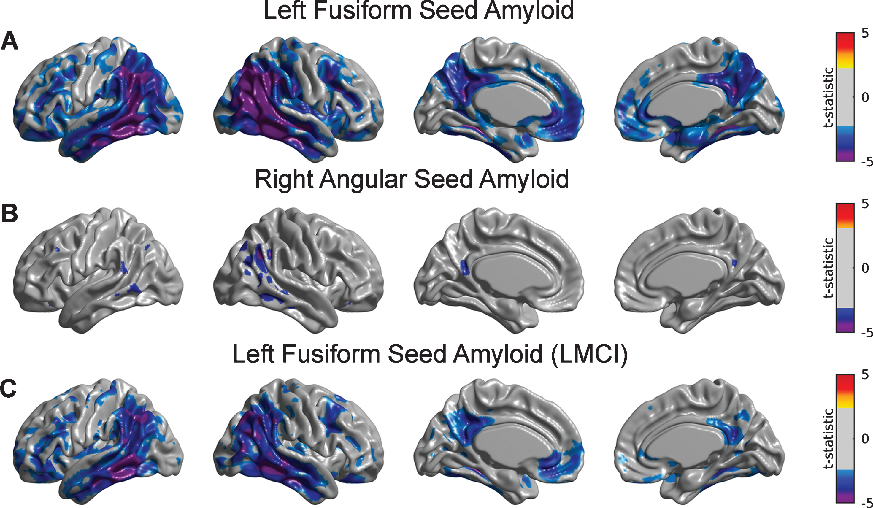 Statistical assessment of seed-based Aβ predictors on glucose metabolism. Cortical surface projections of FDR-thresholded statistically significant regions for the main effect of (A) LFUSI amyloid seed and (B) RANG amyloid seed on metabolism. The Aβ LFUSI seed predicts a significant reduction of glucose metabolism mainly in the inferior temporo-parietal cortex, posterior cingulate cortex, and precuneus. The Aβ RANG seed only predicts a spatially concurrent significant reduction of metabolism in the right angular gyrus itself. C) Effect of LFUSI amyloid seed in metabolism corresponding to the LMCI cohort. Significant regions essentially match those for the case of the whole sample.