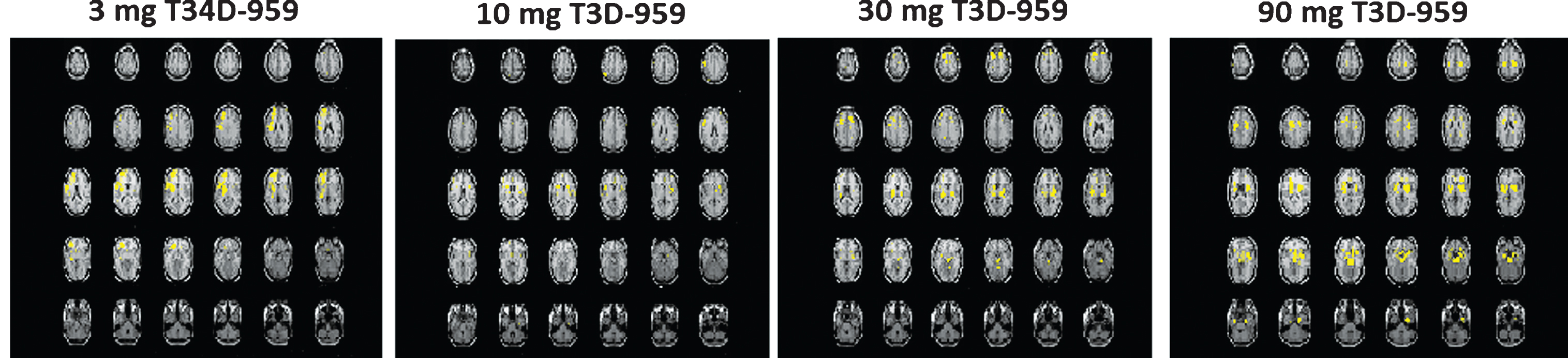 Regions of Statistically Significant Differences (ROSDs) with Positive Δ R CMRgl (EOT-BL) Relative to Whole Brain (p < 0.005) for the four dose groups. Voxel-wise SPM Analysis. Yellow regions (ROSD) represent voxels with statistically significant increases from baseline (BL) to end of treatment (EOT) (positive ΔR CMRgl (EOT – BL)>0, p = 0.005). ROSDs are defined as brain regions where Δ R CMRgl = [voxeli(EOT) / RRave (EOT)] – >0 or <0, with a p value < 0.005 across a dose group. ROSDs are referred to as positive (Δ R CMRgl>0) or negative (Δ R CMRgl<0) ROSDs, and are strictly spatial regions, shown as yellow regions in the image displays. The spatial extent of an ROSD can be quantified by the number of voxels in an ROSD.