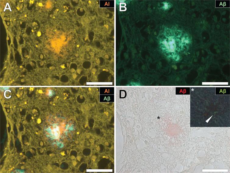 Aluminum and amyloid-β deposition in a senile plaque in the occipital cortex of a donor with familial Alzheimer’s disease (fAD). A) Aluminum is identified using lumogallion as an orange fluorescence emission. B) Thioflavin S (ThS) staining of an adjacent serial section revealed a green fluorescence emission characteristic of amyloid-β. C) Merging of fluorescence channels reveals co-localization of aluminum and amyloid-β. D) Congo red staining confirmed the presence of amyloid-β in the same plaque, producing a red hue under bright-field illumination and apple-green birefringence (magnified insert denoted by an asterisk) under polarized light. Magnification: X 400, scale bars = 50 μm.