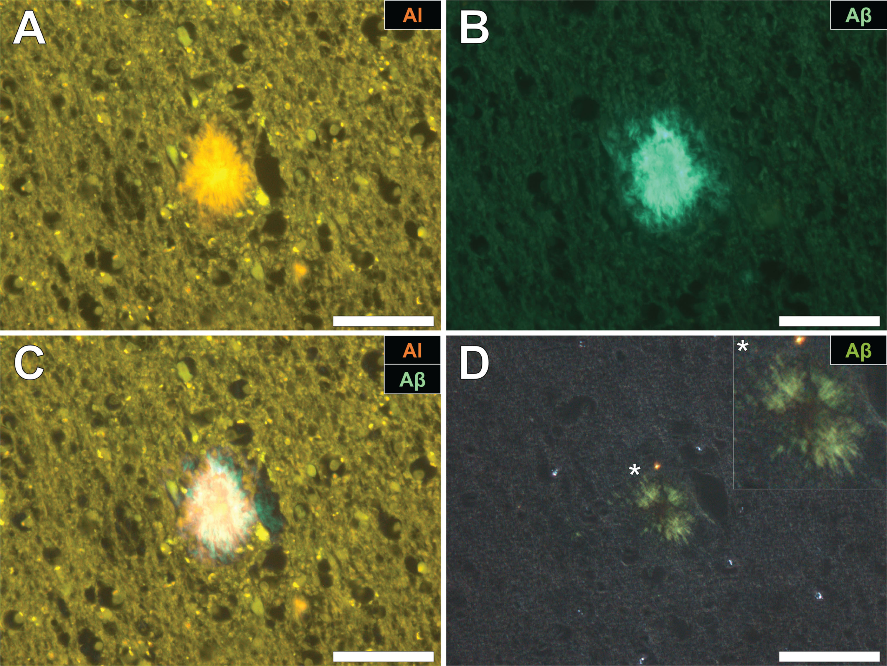 Aluminum and amyloid-β co-located in a senile plaque in the grey-white matter interface of the parietal lobe of a donor with fAD. A) Aluminum was detected via an orange fluorescence emission upon lumogallion staining. B) ThS-reactive fluorescence (green) indicative of amyloid-β in the identical senile plaque. C) Merging of fluorescence channels reveals co-localization of aluminum and amyloid-β. D) Congo red staining of the same tissue region revealed apple-green birefringence in the form of a Maltese-Cross diffraction pattern or spherulite (magnified insert), under polarized light. Magnification: X 400, scale bars = 50 μm.