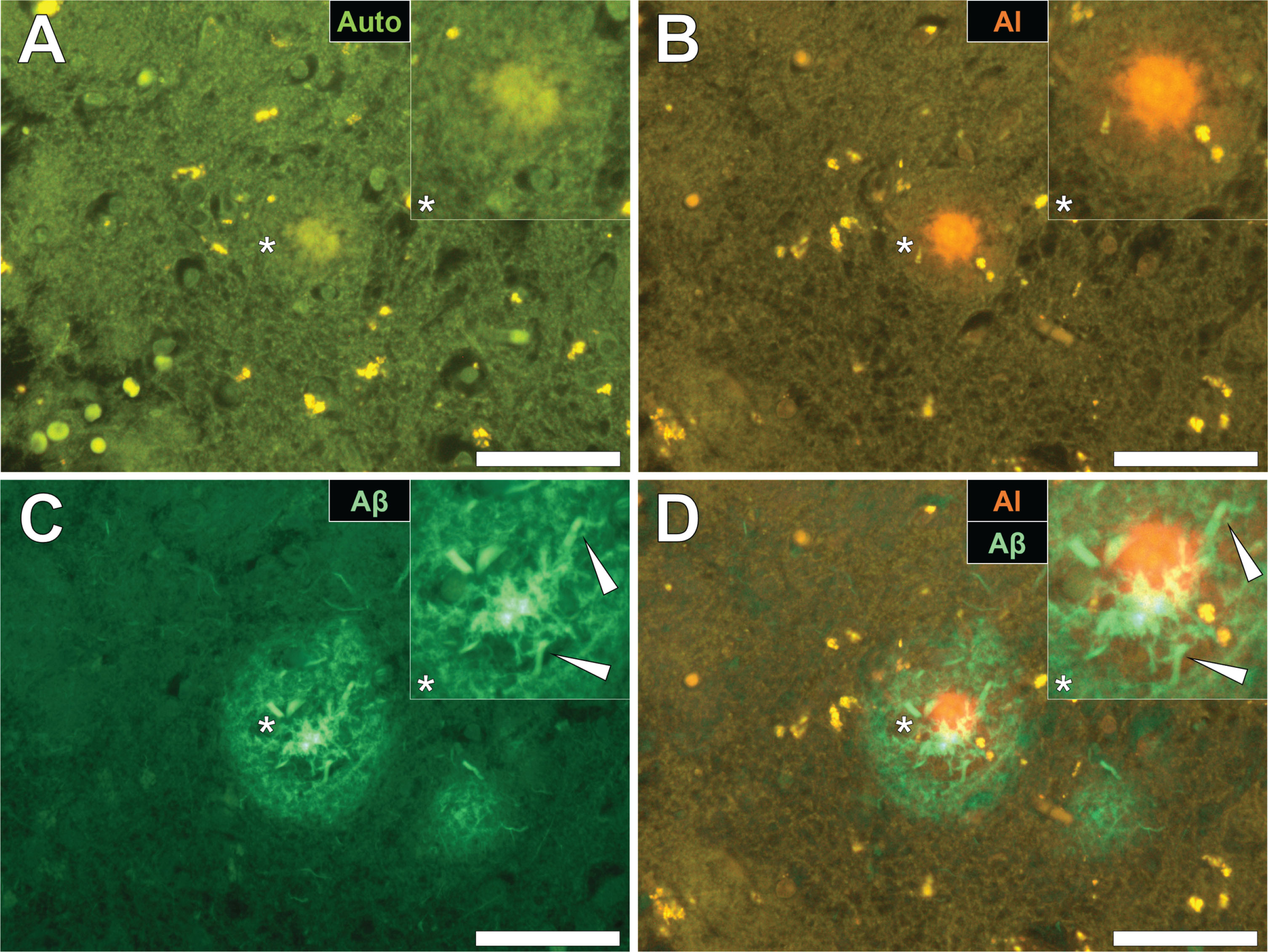 Aluminum deposition in a senile plaque in the temporal cortex of a donor with fAD. A) Autofluorescence of the non-stained section revealed a weak green fluorescence emission of a plaque-like structure. B) Aluminum identified as orange fluorescence upon lumogallion staining. C) ThS staining showed the presence of a senile plaque via an intense green fluorescence emission. D) Merging of the lumogallion and ThS fluorescence channels identified aluminum at the core of the senile plaque with ThS reactive threads of amyloid-β identified at its periphery (white arrows). Magnified inserts are denoted by asterisks in the respective fluorescence micrographs. Magnification: X 400, scale bars = 50 μm.