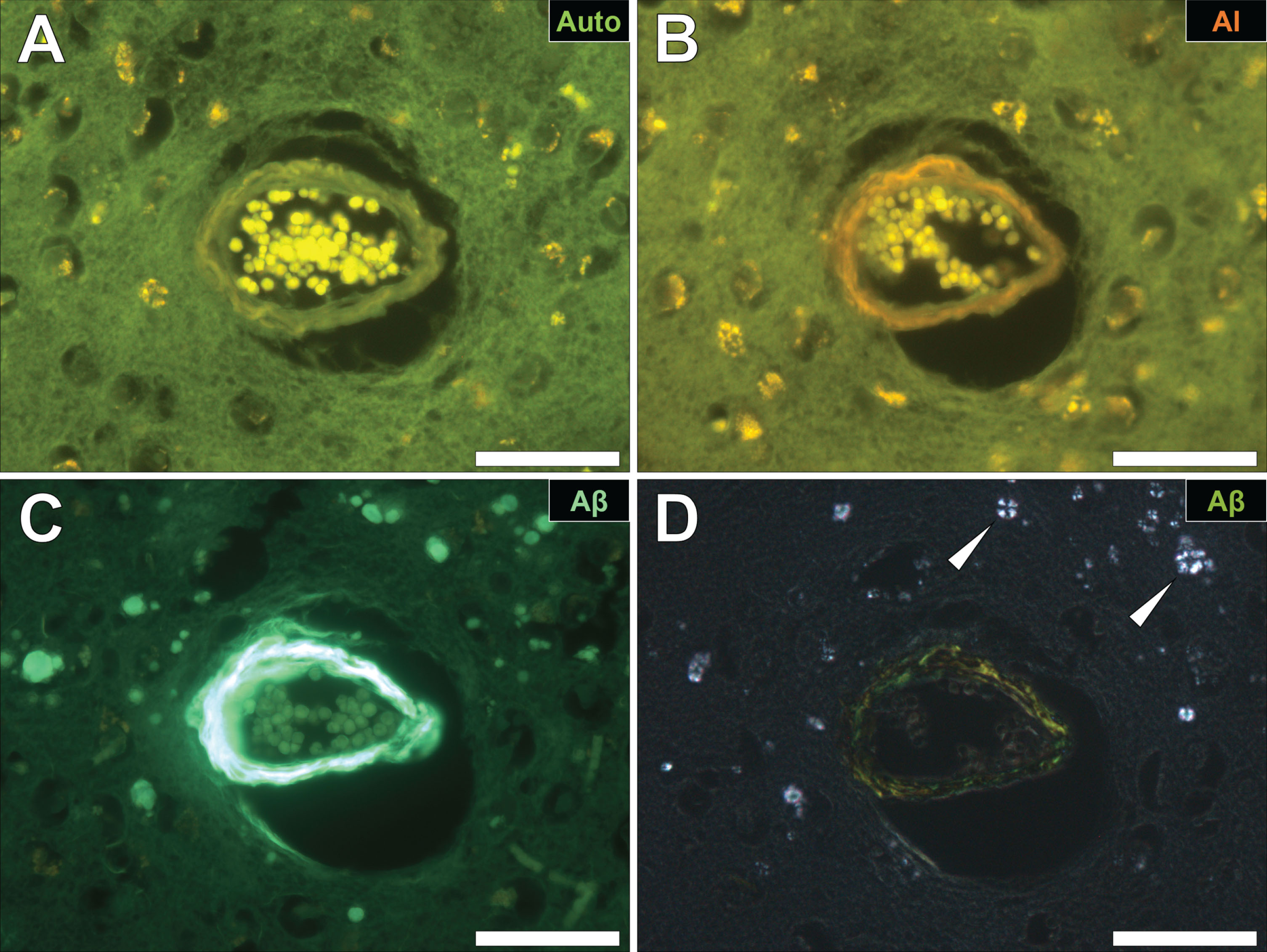 Cerebral amyloid angiopathy (CAA) in a blood vessel in the frontal cortex of a donor with fAD. A) Autofluorescence revealed a weak green fluorescence emission of the vessel wall. B) Lumogallion revealed the presence of aluminum (orange fluorescence) in the same vessel. C) Positive ThS-staining identifies amyloid-β in the vessel wall. D) Apple-green birefringence when stained with Congo red under polarized light is indicative of amyloid-β in a β sheet conformation. White arrows highlight mineralized deposits appearing as spherulites, producing a Maltese-Cross diffraction pattern. Magnification: X 400, scale bars = 50 μm.