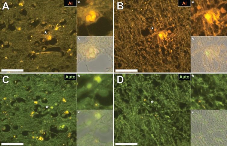 Intracellular aluminum in glial cells in the occipital cortex (A) and in neuronal axons in white matter of the parietal lobe (B) of donors with fAD. C, D) Autofluorescence of unstained serial sections confirming the presence of aluminum. Magnified inserts are denoted by asterisks in the respective fluorescence micrographs. Magnification: X 400, scale bars = 50 μm.