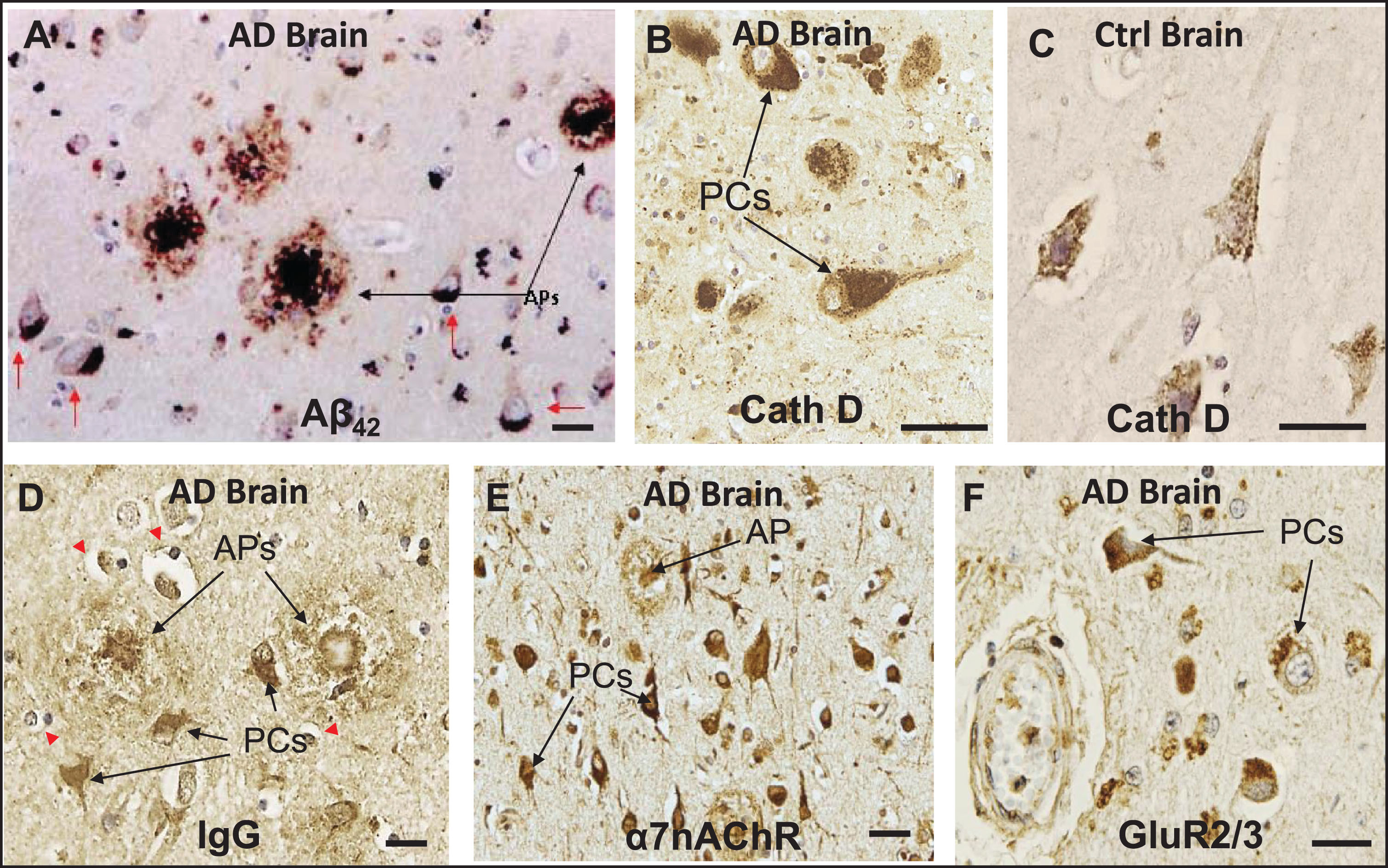 In neurons of AD brains, exogenous Aβ42 and IgG are internalized along with key cell surface proteins and deposited within the lysosomal compartment. A) IHC of a histological section of cerebral cortex of AD brain showing deposition of Aβ42 in amyloid plaques (APs) and in pyramidal cells (PCs). B, C) Cathepsin D (CathD) immunostaining reveals a great expansion of the lysosomal compartment in PCs in AD brains over that of controls. D) Section of AD brain showing preferential affinity of IgG for certain PCs and APs, along with adjacent non-reactive, IgG immuno-negative cells. E) IHC shows intense α7nAChR-positive immunostaining in PCs, and α7nAChR was also detected throughout dense-core APs, supporting the possibility that at least some APs are derived from the death and lysis of local Ig- and Aβ42-overburdened PCs. F) A similar localization pattern was seen in PCs for GluR2/3, a surface receptor found with intracellular distribution, in the vicinity of the cerebrovasculature. Red arrows, Aβ42-burdened neurons. Red arrowheads, IgG immuno-negative cells. Scale bar = 20 μm.
