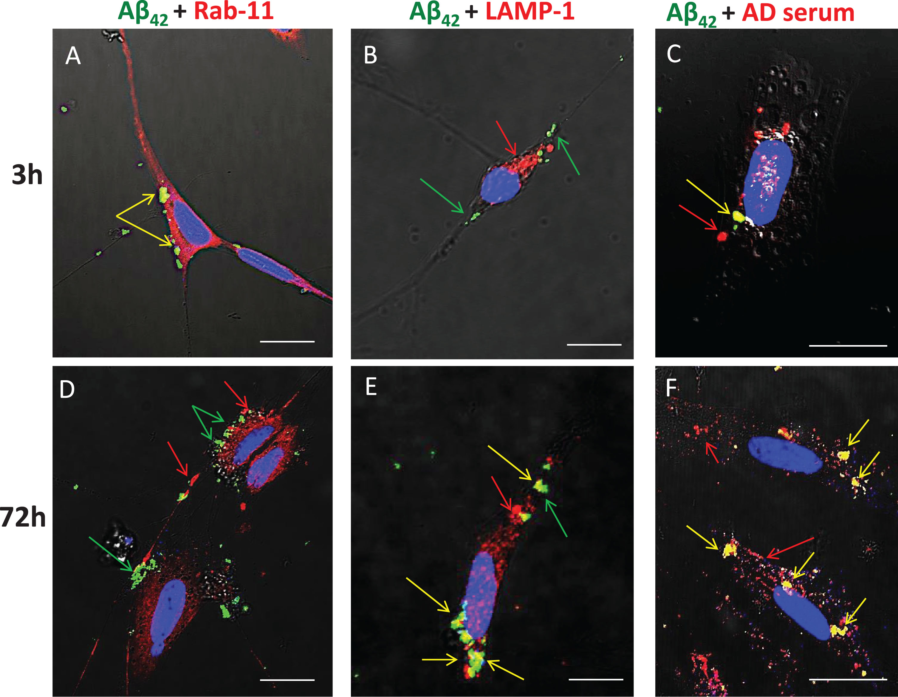 Aβ42 is trafficked through endosomes (Rab11) to the lysosome compartment (LAMP-1) following internalization. SH-SY5Y treated from 3 to 72 h with FITC-Aβ42 with or without AD serum. ICC was used to detect Rab-11 (early endosomes) and LAMP-1 (late endosomes/early lysosome marker). Co-localization was detected by superposition of red and green signals to yield yellow fluorescence. At 3 h, nearly all internalized FITC Aβ42 was associated with early endosomes (Rab-11). In cells treated for 3 h and 72 h with FITC Aβ42 in the presence of serum from an AD patient, co-localization of Aβ42 and IgG was evident, although some internalization of Aβ42 also occurred independently of IgG. At 72 h, little or no co-localization of Aβ42 with Rab11 was detected, but significant accumulations of co-localized Aβ42 and LAMP-1 (lysosomes) were common. Rab-11, early endosome; LAMP-1, lysosomal marker; AD, Alzheimer’s disease human serum; green arrow, Aβ42; red arrow, secondary protein of interest; yellow arrow, co-localization; **p < 0.01; ***p < 0.001; Scale bar = 10 μm.