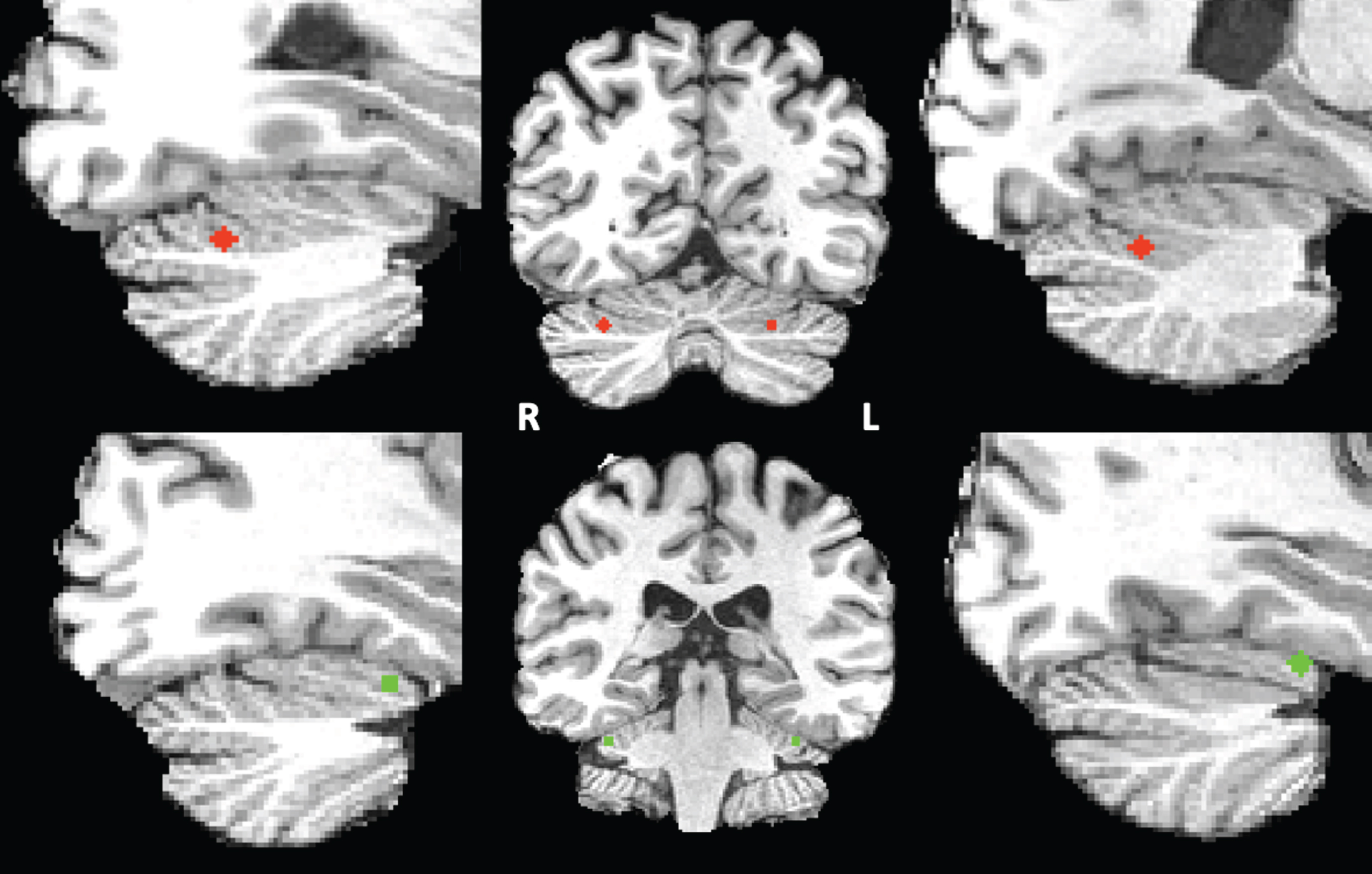 Right and left cerebellar DMN (red) and VAN (green) seeds superimposed on the T1 images of one of the participants.