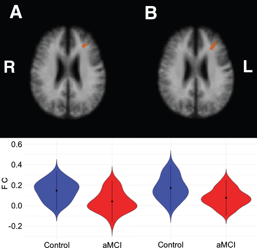 Left middle frontal clusters showing significant correlations with the left cerebellar VAN seed (A) and right cerebellar VAN seed (B), respectively. The bottom row shows violin plots corresponding to the distribution of the functional connectivity within the clusters for each group, blue = controls, red = aMCI.