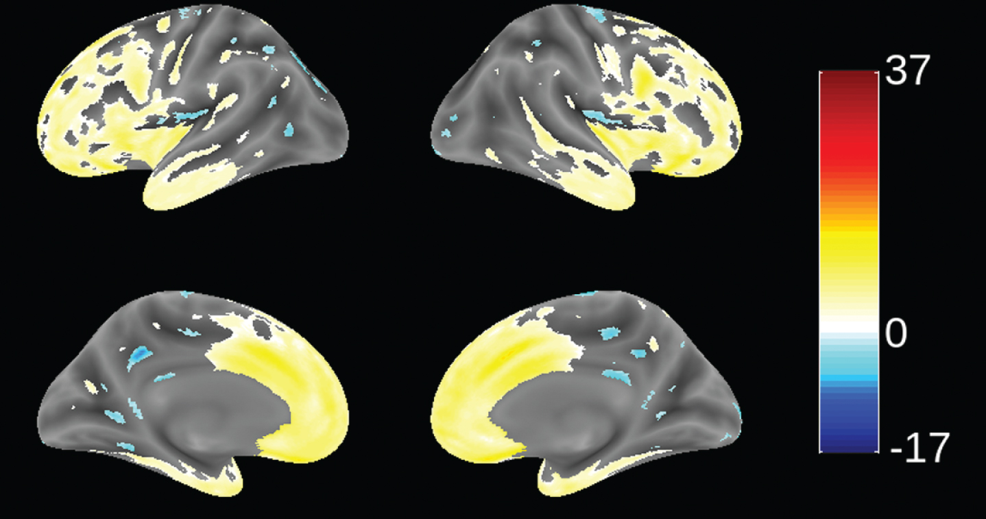 Voxel-based morphometric comparison showing regions of greater atrophy (yellow) in patients with bvFTD compared to AD patients with mild AD (n = 713), from study TRx-237-005, controlled for age, sex, and total intracranial volume of each individual. Blue color indicates greater atrophy in AD patients. Data are displayed at a significance threshold corrected for family-wise error at the whole brain level at p < 0.05.
