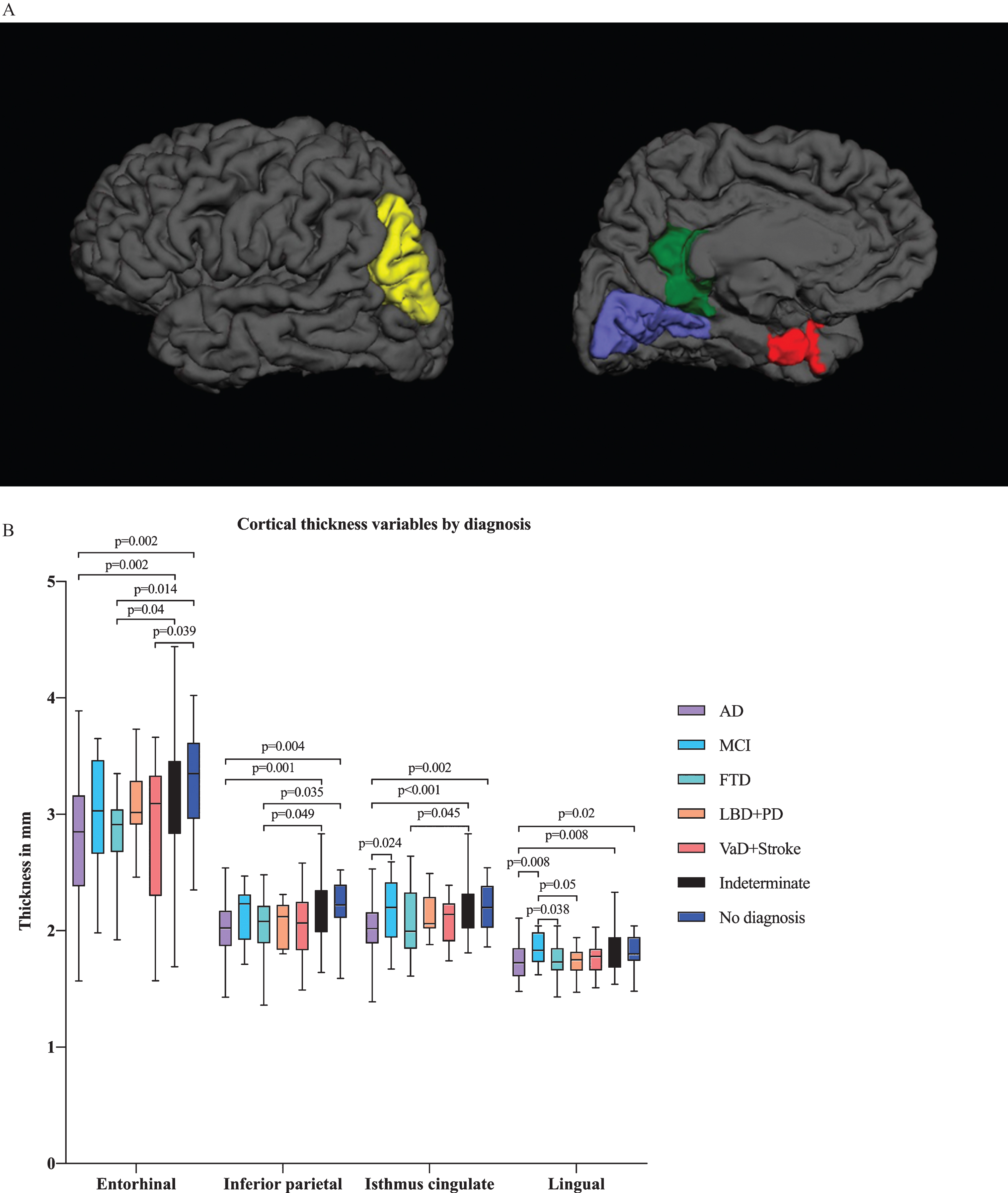 A) Illustration of cortical thickness regions of interest (ROIs) from the ANCOVA model by diagnostic group from lateral and medial views. The ANCOVA model by clinical diagnosis resulted in ROIs including entorhinal, lingual, inferior parietal and isthmus cingulate cortical thicknesses. Red refers to the entorhinal cortex, blue to the lingual cortex, green to the isthmus cingulate cortex and yellow to the inferior parietal cortex. B) Cortical thickness variables by diagnostic group. Only the p-values from significant comparisons are shown.