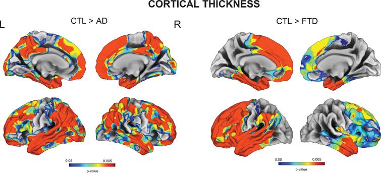 Vertex-wise cortical thickness group comparisons between Controls, AD, and FTD (FDR-corrected p < 0.05).