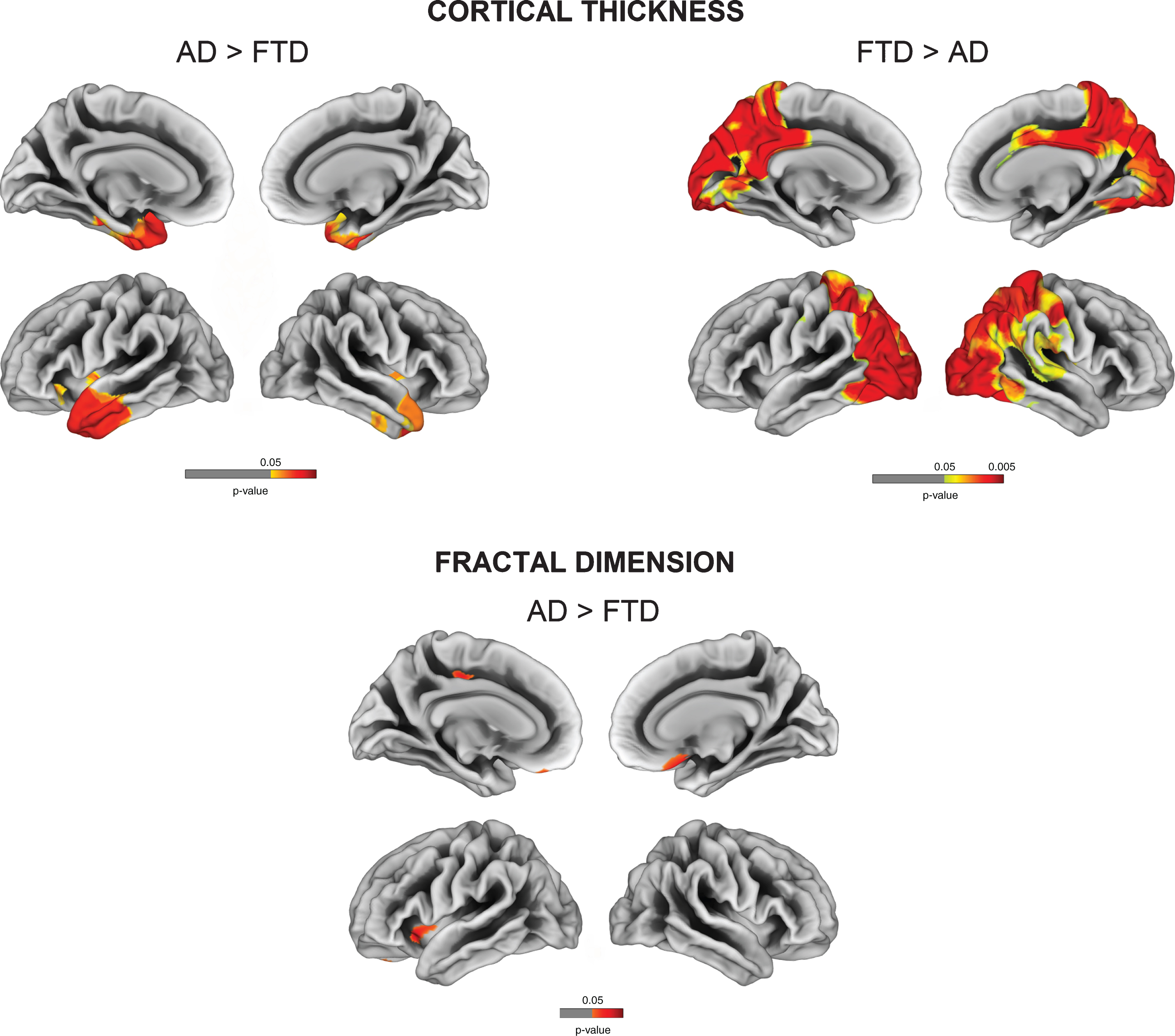 Vertex-wise cortical thickness and fractal dimension comparisons between AD and FTD (FDR-corrected p < 0.05).