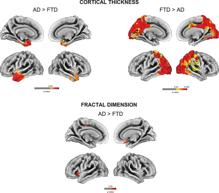 Vertex-wise cortical thickness and fractal dimension comparisons between AD and FTD (FDR-corrected p < 0.05).