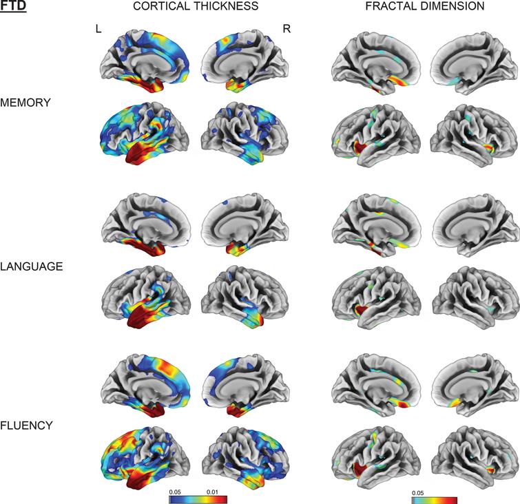Vertex-wise cortical thickness and fractal dimension correlate of memory, language and fluency impairment for the FTD group (FDR-corrected p < 0.05). L, left; R, right.