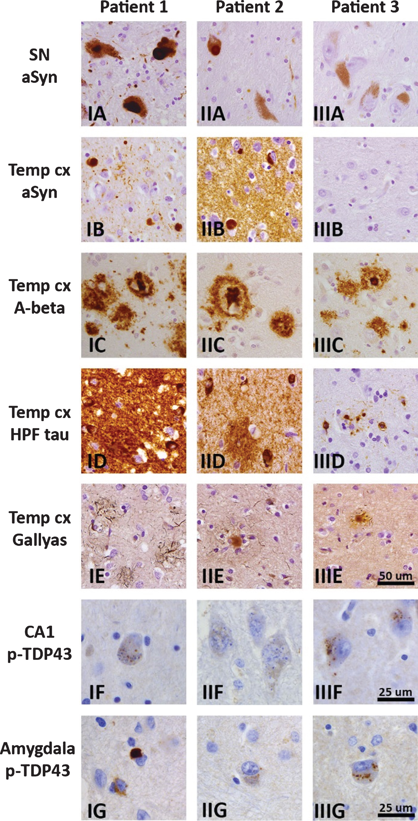Brain pathology in three patients with possibly pathogenic LRP10 variants, with representative photomicrographs of selected brain regions for Patient 1 (IA–G), Patient 2 (IIA–G), and Patient 3 (IIIA–G). Immunohistochemistry for α-synuclein (clone KM51) showed Lewy bodies and Lewy neurites in brainstem, limbic and neocortical brain areas in Patients 1 and 2 (I–IIA, B), but no α-synuclein immunoreactivity in Patient 3 (IIIA, B). Diffuse and cored amyloid-β plaques (clone 6F/3D) were present in neocortical regions, amygdala, and striatum in all three patients, and extended into the CA4 region, midbrain, and cerebellum in Patients 1 and 3. Amyloid-β positive plaques in the temporal pole are shown in panel I–IIIC. Immunostaining for hyperphosphorylated tau (clone AT8) showed neurofibrillary tangles, threads, and plaques in the hippocampus and temporal pole in all three patients, and extended into the peristriate and striate areas of the occipital cortex in Patient 1. A moderate or high load of neurofibrillary pathology was present in the temporal pole in Patient 3 (IIID), and Patients 1 and 2 (I–IID), respectively. Gallyas silver stain showed a moderate or high load of neuritic plaques in neocortical regions in Patients 2 and 3 (IIE, IIIE), and Patient 1(IE), respectively. Immunostaining for phospho-TDP43 (polyclonal rabbit antibody) showed granulovacuolar degeneration in the hippocampus and amygdala of all three patients (I–IIIF, II–IIIG). Additionally, Patient 1 showed TDP-43-positive neuronal inclusions and threads in the amygdala fitting limbic-predominant age-related TDP-43 encephalopathy (LATE; IG). Scalebar in IIIE represents 50μm and applies to panels A–E. Scalebars in IIIF and IIIG represent 25μm and apply to panels I–IIIF-G. SN, substantia nigra, Temp cx, temporal pole.