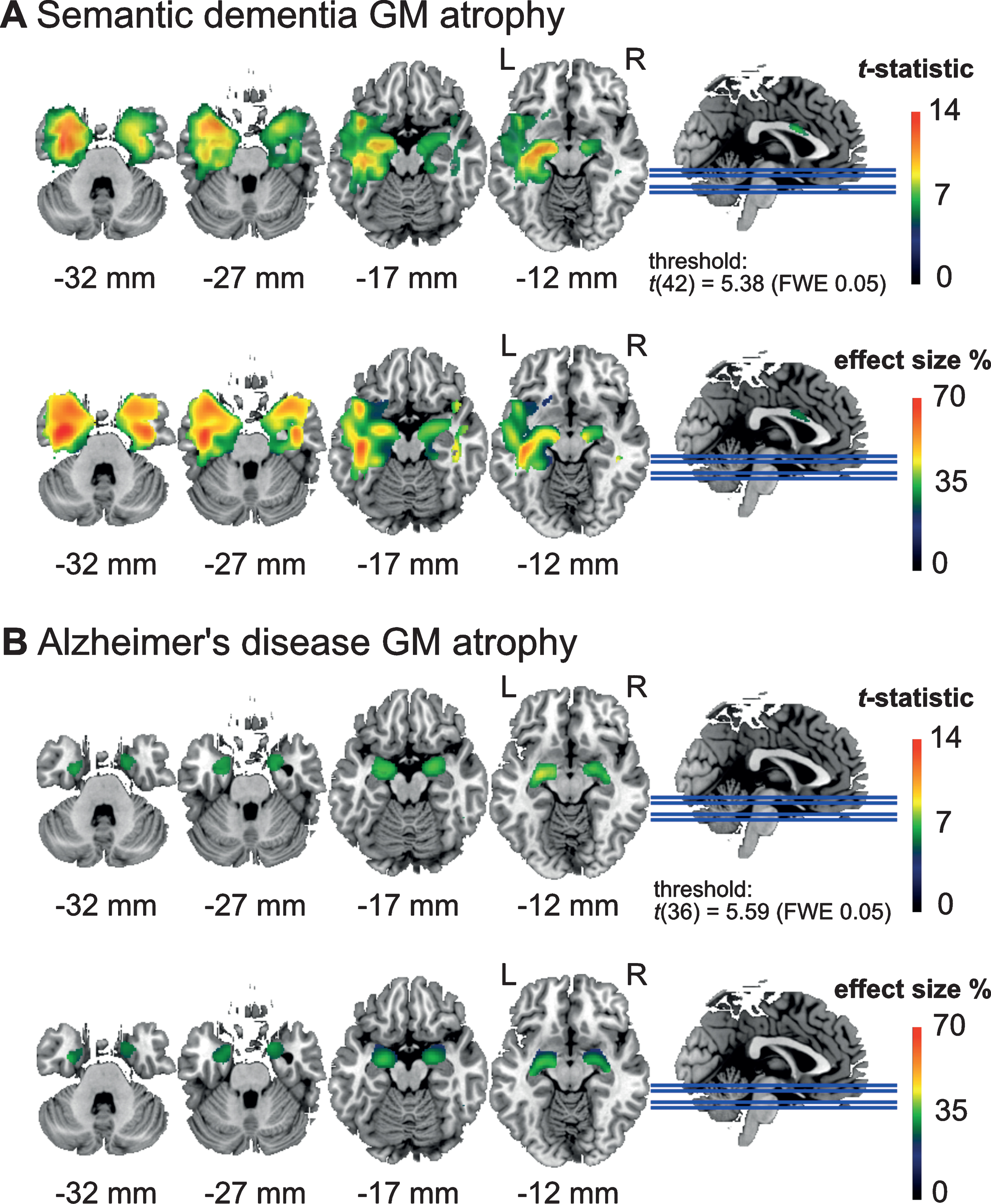 Areas with significantly lower (voxel-level) gray matter (GM) density (top) and effect size in terms of percentage GM reduction (bottom) in (A) the semantic dementia (SD) patients (n = 24) and (B) Alzheimer’s disease (AD) patients (n = 18) compared to the healthy elderly control group (n = 20). SD patients showed reduced GM density in widespread areas of the left anterior temporal cortex including the temporal pole, while the AD patients showed reduced GM density in the amygdala. SD patients showed more severe GM loss with up to 70% reduction, and AD patients with up to 40% reduction in some areas.