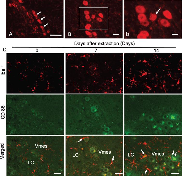 Degeneration of Vmes neurons and the activation of microglia after tooth extraction. A) Aβ42 (BC05)-IR Vmes neurons (arrows) in 4-month-old 3×Tg-AD mice. B) Two weeks after tooth extraction a damaged Aβ42-IR neuron with an unclear cell membrane was observed. b) A higher magnification image of the rectangular area in (B). C) Immunofluorescence images of CD86-IR and Iba1-IR microglia after tooth extraction. Immunofluorescence images of microglia in the Vmes and LC at 0 (Con), 7, and 14 days after tooth extraction. Immunofluorescence images of Iba1-IR, and CD86-IR cells and merged images. The arrows indicate Iba1+/CD86+ microglia. Double arrows indicate an Iba1–/CD86+ cell. Scale bars: A, 100μm; B, 30μm; b, 10μm; C, 50μm.