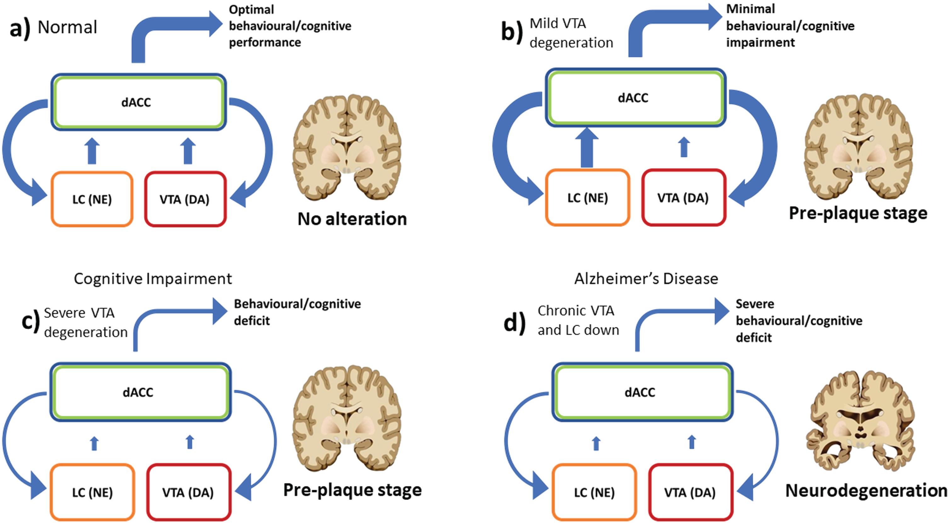 Schema summarizing the interaction between dACC modules and catecholamine modules in the RML, during the progressive degeneration of VTA. Coronal brain sections indicating the possible presence of diffusive degeneration. a) In normal conditions, dACC modules make decisions and optimize catecholamines release to maximize performance (i.e., reward). b) In case of mild VTA degeneration, the dACC can compensate the VTA loss (DA: dopamine), by upregulating the boosting signal (functional reserve, ticker blue downward arrows). This compensates only partially the VTA degeneration (due to neural cells loss), but increases strongly the LC (NE: norepinephrine) output as the LC is not impaired, at least during early stages of the disease. This keeps behavioural performance close to normal, at least for easy tasks, but with a higher recruitment of catecholamines. c) When the VTA degeneration is severe the cost for compensation is too high, and therefore the dACC decreases the boosting signal (thinner downward arrows), causing a downregulation of both LC and an even stronger VTA output decrease. This causes the behavioural deficits described in Figs. 2 and 3, including the WM impairment due to the loss of LC function. d) Chronic catecholamines down-regulation leads to severe cognitive impairments and possibly to a lower clearance of Aβ peptide in LC target areas, thus contributing to the disease progression toward the plaque stage.