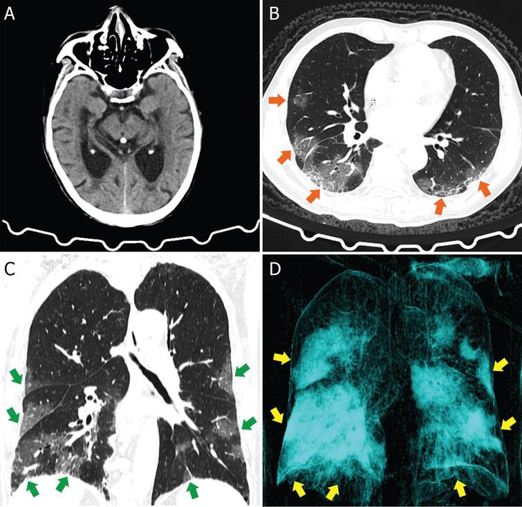 Head and Chest CT images of an AD patient. A) Head CT image showed cerebral atrophy. B) Axis scan chest CT image showed bilateral patchy ground-glass opacities (orange arrows). C) Corona scan chest CT image showed bilateral multifocal ground-glass opacities (green arrows). D) Three-dimensional reconstruction image showed the lesions (yellow arrows).