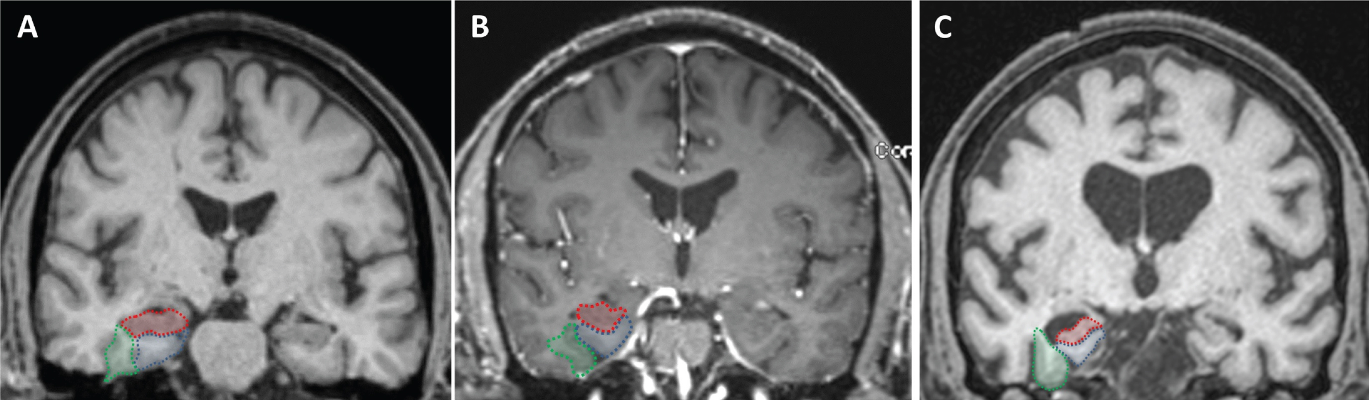Visual rating system for assessing medial temporal atrophy. The three regions of interest are outlined in the right hemisphere in color (hippocampus in red; entorhinal cortex in blue; perirhinal cortex in green). Control subject (A) and subject with MCI (B), all showing no atrophy (MTA score = 0) in both hemispheres. Subject with dementia (C), all structures have atrophy (right MTA score = 3.3 and left MTA score = 2.3).