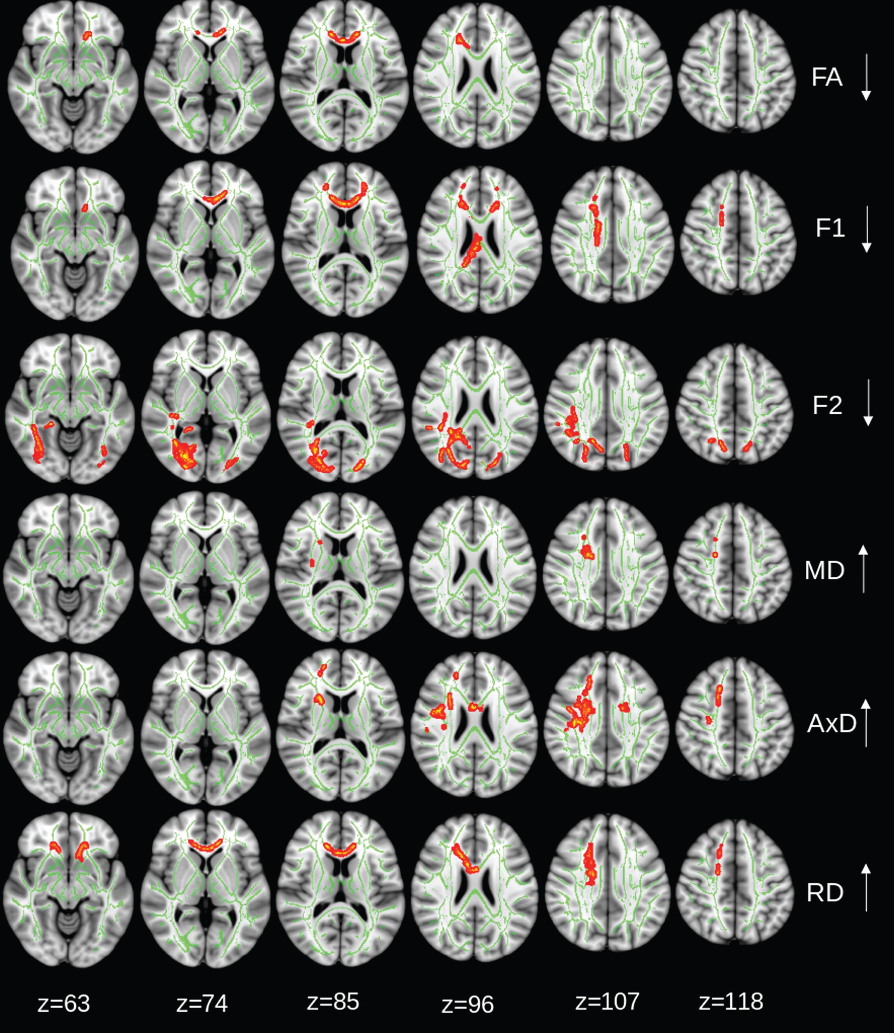 Control group: regions of significant changes in diffusivity parameters during the 2-year trial are projected on the skeleton (green) of the white matter (p < 0.05, corrected for family-wise error). Decreasing FA, diffusivity along domain (F1, trend p < 0.08), and non-domain diffusion orientation (F2), and increasing mean diffusivity (MD), axial diffusivity (AxD), and radial diffusivity (RD) shown in red-yellow.