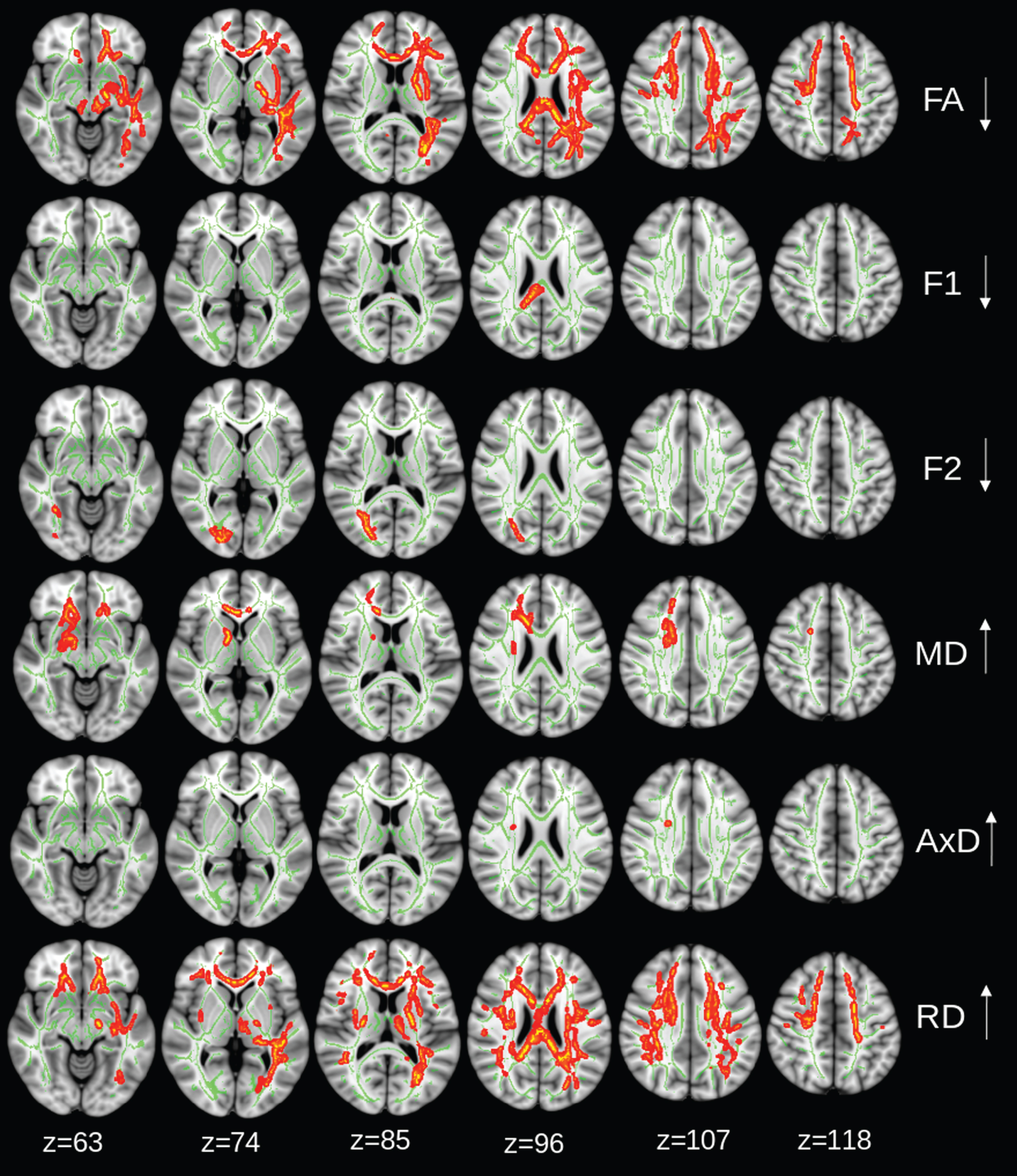 Intervention group: regions of significant changes in diffusivity parameters during the 2-year trial are projected on the white matter skeleton (green) (p < 0.05, corrected for family-wise error). Decreasing fractional anisotropy (FA), diffusivity along domain (F1), and non-domain diffusion orientation (F2), and increasing mean diffusivity (MD), axial diffusivity (AxD), and radial diffusivity (RD) are shown in red-yellow.