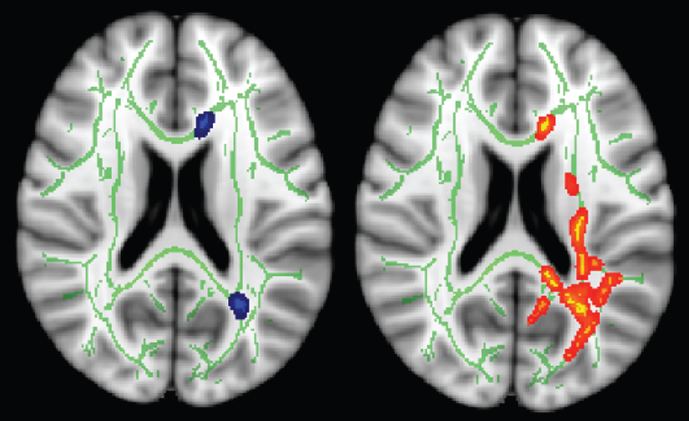 Additional ROI analysis where Fraction anisotropy (FA) values at baseline and follow-up were measured from anterior- and posterior-periventricular regions (left, blue). The red-yellow (right) areas indicate the tracts with significant difference in longitudinal FA changes between control and intervention groups.