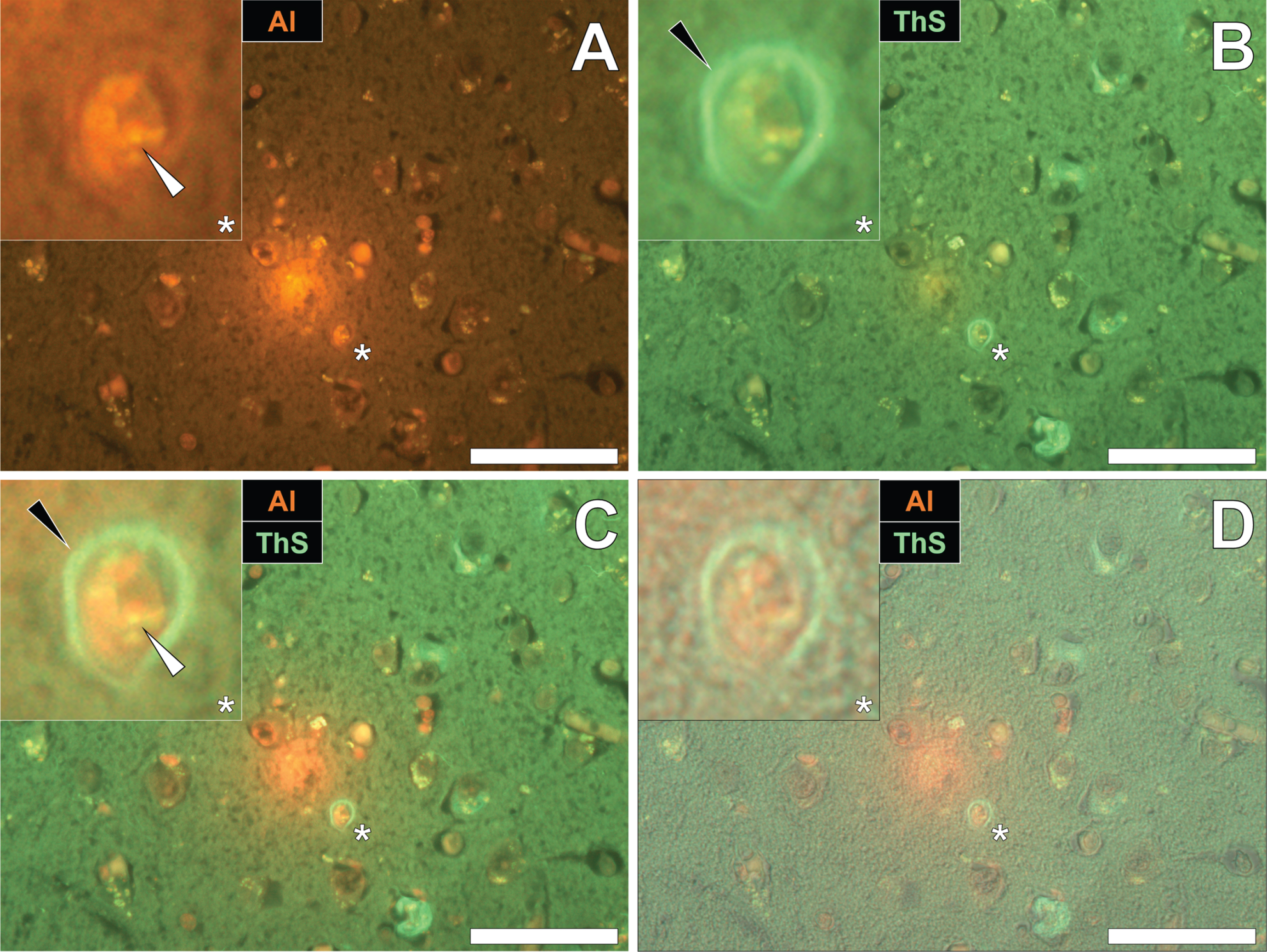 Intracellular aluminum co-located with ThS-reactive NFTs in the temporal cortex of a Colombian donor (Case 90: Female, aged 45) with fAD (PSEN1-E280A mutation). A) Punctate intracellular aluminum (orange, white arrows) in neuronal cells exhibiting positive (green) fluorescence for (B) intraneuronal NFTs (black arrows) with (C) merging of fluorescence channels and the brightfield overlay (D) depicting their co-deposition. Magnified inserts are denoted by asterisks in the respective fluorescence micrographs. Al, aluminum; ThS, thioflavin S. Magnification: X 400, scale bars: 50μm.