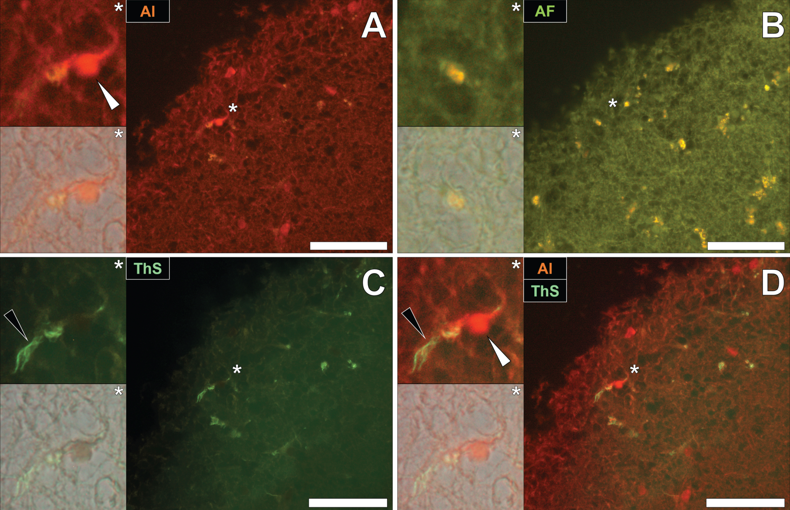 Intracellular aluminum co-located with ThS-reactive NFTs in neurons in the temporal cortex of a 60-year-old male donor with epilepsy. A) Intranuclear aluminum (orange, white arrows) and (B) autofluorescence of the non-stained section. C) The identical neuronal cell exhibiting positive (green) fluorescence for NFTs (black arrows) with (D) merging of fluorescence channels depicting their co-localization. Magnified inserts are denoted by asterisks in the respective fluorescence micrographs of which merging of the brightfield overlay is depicted in the lower panels. Al, aluminum; ThS, thioflavin S. Magnification: X 400, scale bars: 50μm.
