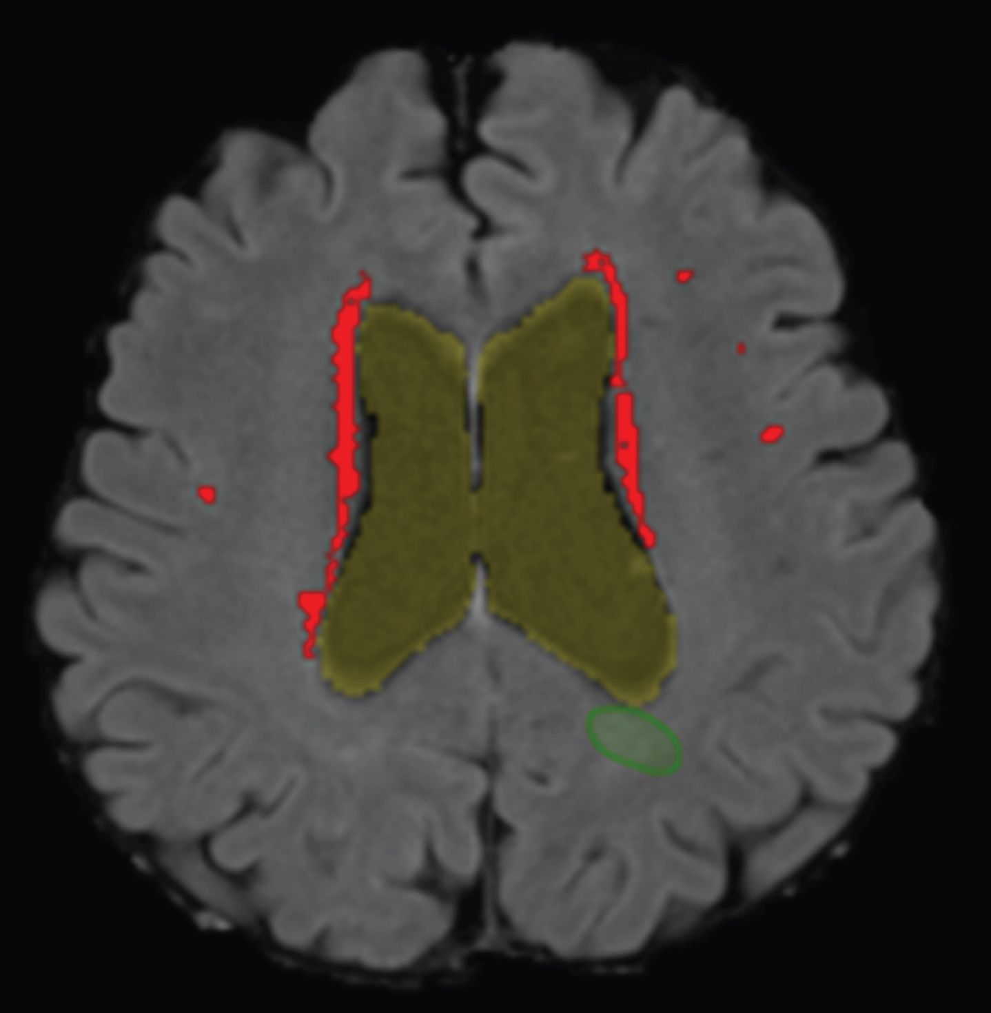 WMH detection on a structural MRI scan. Segmentation of the WMHs detected by the computer aided detection system in the transverse plane projected on a T1-weighted MRI scan of an AD patient. Periventricular WMHs are indicated in red/light gray. Of note, the 
(green) circumference, right under ventricle, indicates a false positive WMH and was removed during post-processing.