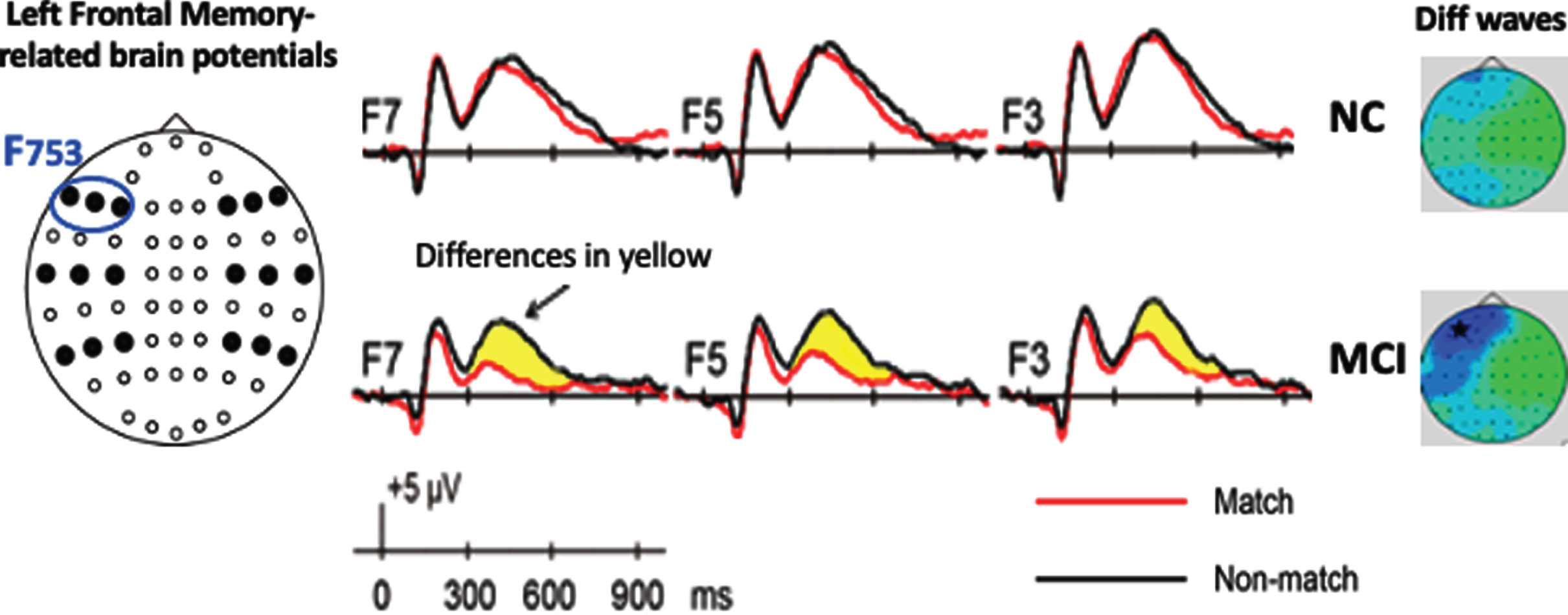 A. F753 is averaged left frontal memory-related potentials of F3, F5, and F7. The blue circle indicates location of left frontal sites from left to right F7, F5, and F3. Baseline memory-related potentials and topographical maps in Normal Cognition (NC) and patients with MCI groups (adapted from [12]). The yellow highlight indicates the differences (diff) of memory-related potentials (Target Match – Nontargets Nonmatch).