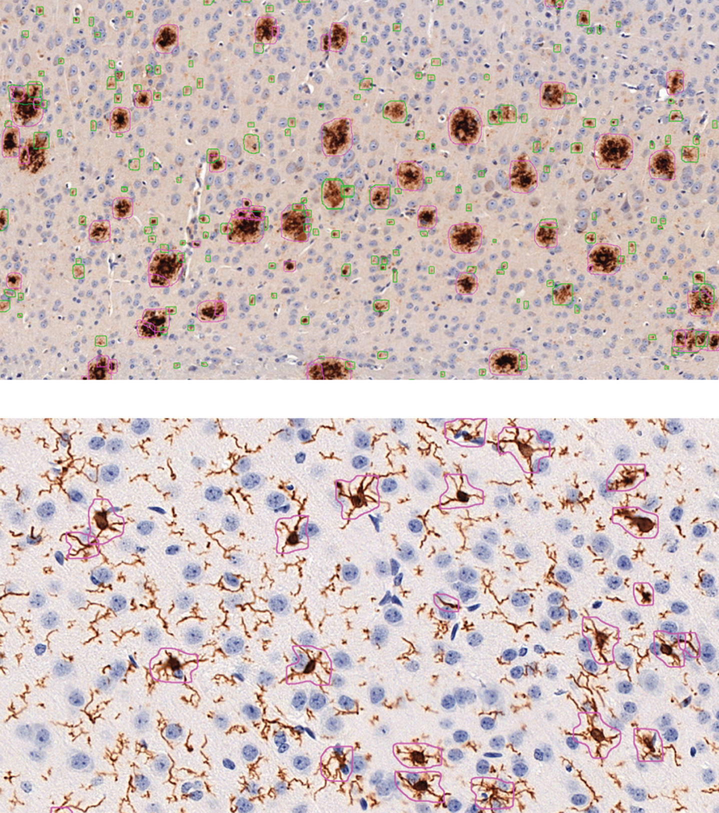 Example images of automatic analysis with DeePathology STUDIO for Aβ (above; anti-Aβ (clone 4G8) staining) and microglia (below; anti-Iba1 staining). Aβ analysis was trained to distinguish between diffuse- (green) and dense-packed (pink) plaques. Microglial analysis was set to detect only activated microglia but no isolated projections or resting microglia.