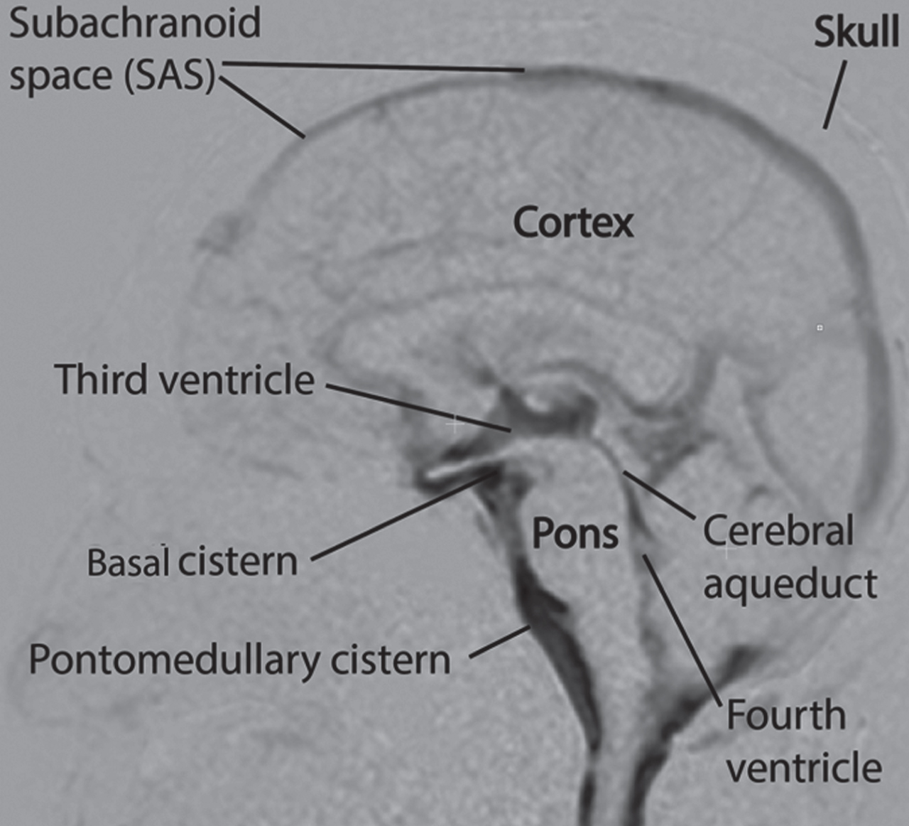 Zones of chaotic/“turbulent” CSF motion in black (most intense) and shades of gray (less intense). These zones are found mainly around the brainstem, cisterns, third ventricle, spinal cord, and to a lesser extent, cortex SAS. This MRI study was on a healthy human subject. Source: [18] licensed under Creative Commons Attribution-Non Commercial-No Derivative International. Alteration permission granted by authors.