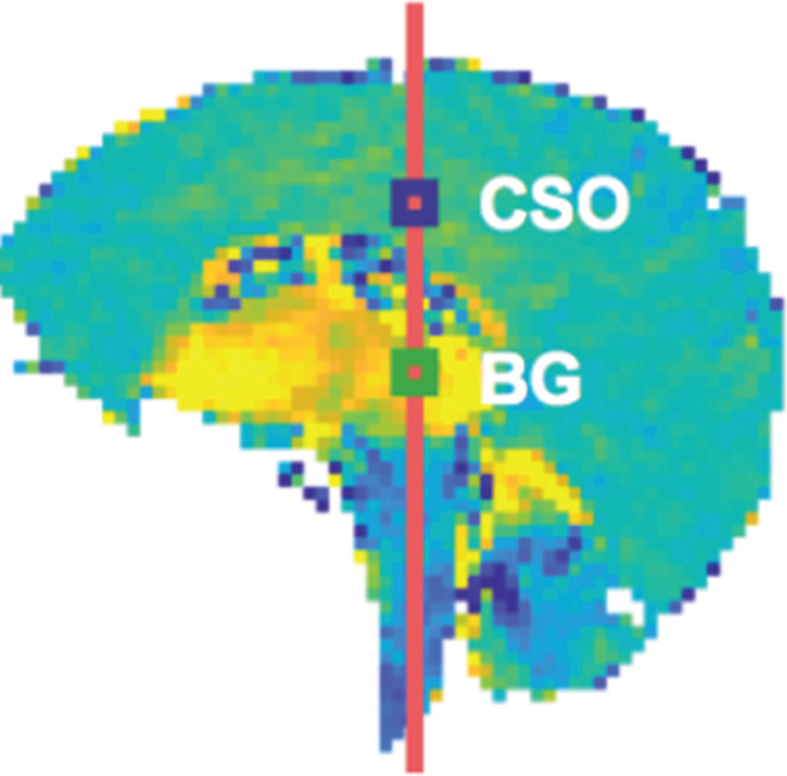Whole brain tissue mechanical strain at the peak systole maximum in comparison with that at early systole. Yellow is maximum strain in the direction of the head and blue is strain at the same time in the direction of the feet. CSO and BG are two different sampling regions. Strain intensity change regions in this figure correlate spatially with turbulence region data in Fig. 5. Source [23] licensed under Creative Commons 4.0.