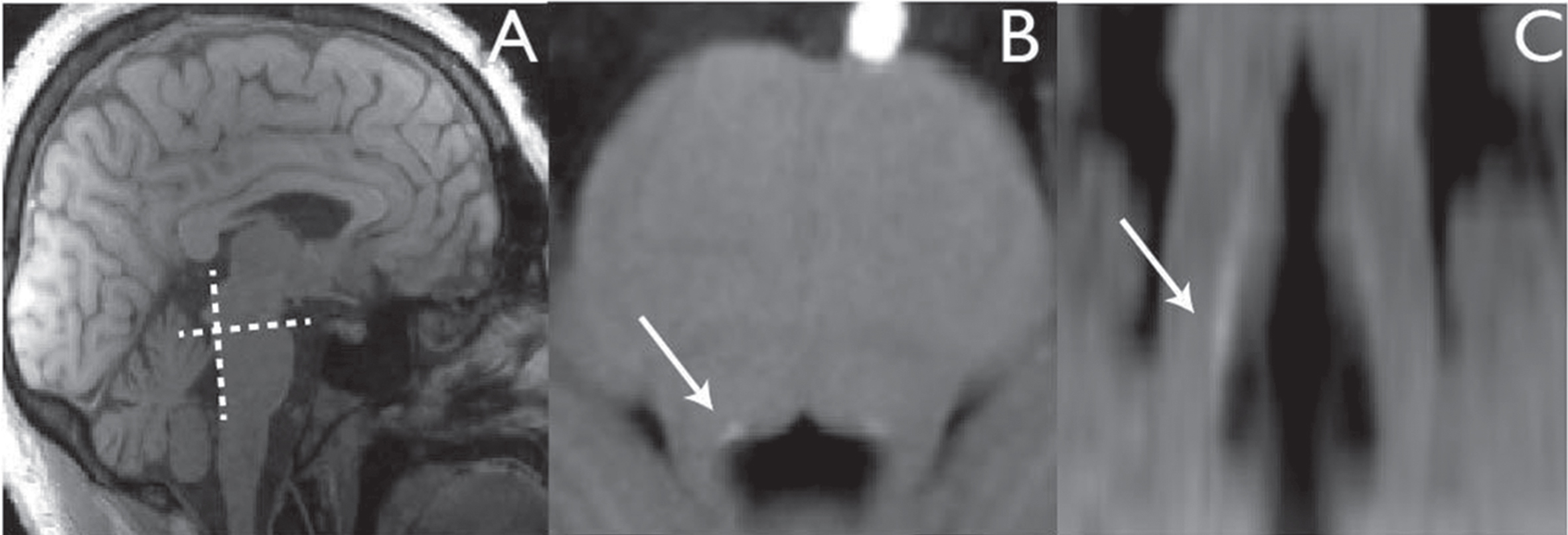 Visualization of human LC as an MRI hyperintense signal in the brainstem using T1-weighted MRI optimized to enhance neuromelanin LC content (white arrows), seen in axial (B) and coronal (C) planes acquired as shown in (A). Source [51] with permission.