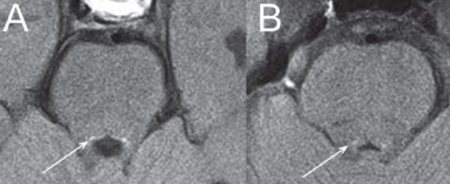 Contrast in LC (white arrow) environment in cerebral aqueduct in (A) a healthy patient; (B) Parkinson’s disease patient with early symptoms.Source [52] with permission.