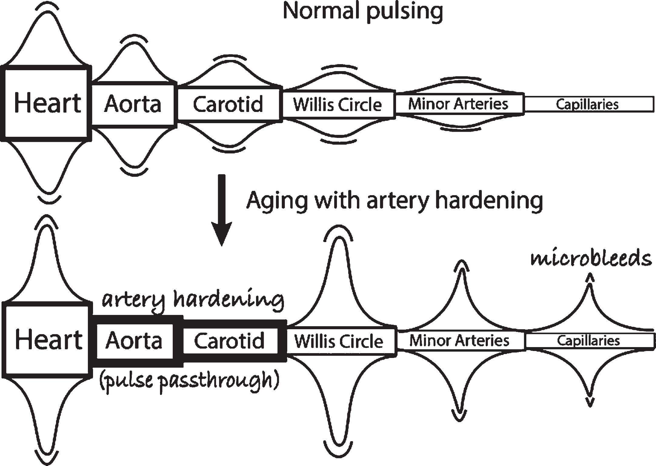 Vascular pulsing that is primarily responsible for CSF flow –the effects of aging and artery hardening. The aorta and carotid harden and lose their flexibility that is responsible for steady capillary flow (upper figure). But artery hardening causes intense heart pulses to pass through these two major arteries and increases the pulse intensity motion in the circle of Willis, the minor arteries, and capillaries, causing microbleeds [55]. Thus, the increased pulse intensity in the circle of Willis with age should be responsible for increased chaotic CSF flow in the neighborhood of the circle of Willis, namely in the basal cistern and its direct CSF connections. This increased motion could lead to higher energy Aβ and tau molecular states that are precursors to neurotoxic seeds, thus possibly initiating Aβ seeds leading to AD.