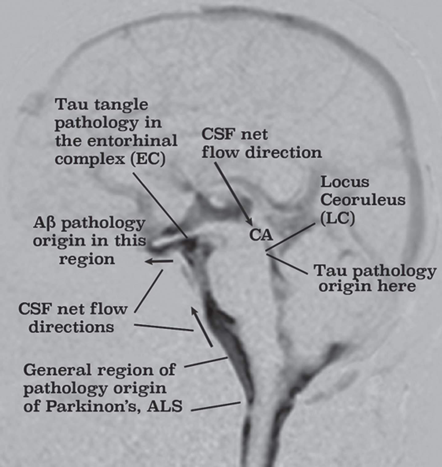 Origins of Aβ and tau AD pathology correlates with black areas revealing regions in which CSF motion is either chaotic and/or flowing from a chaotic flow region. Parkinson’s and ALS pathology also originate in the lower brainstem region where motor nerves jut into chaotic CSF. Source: [18] Licensed under a Creative Commons Attribution-NonCommercial-NoDerivatives International.