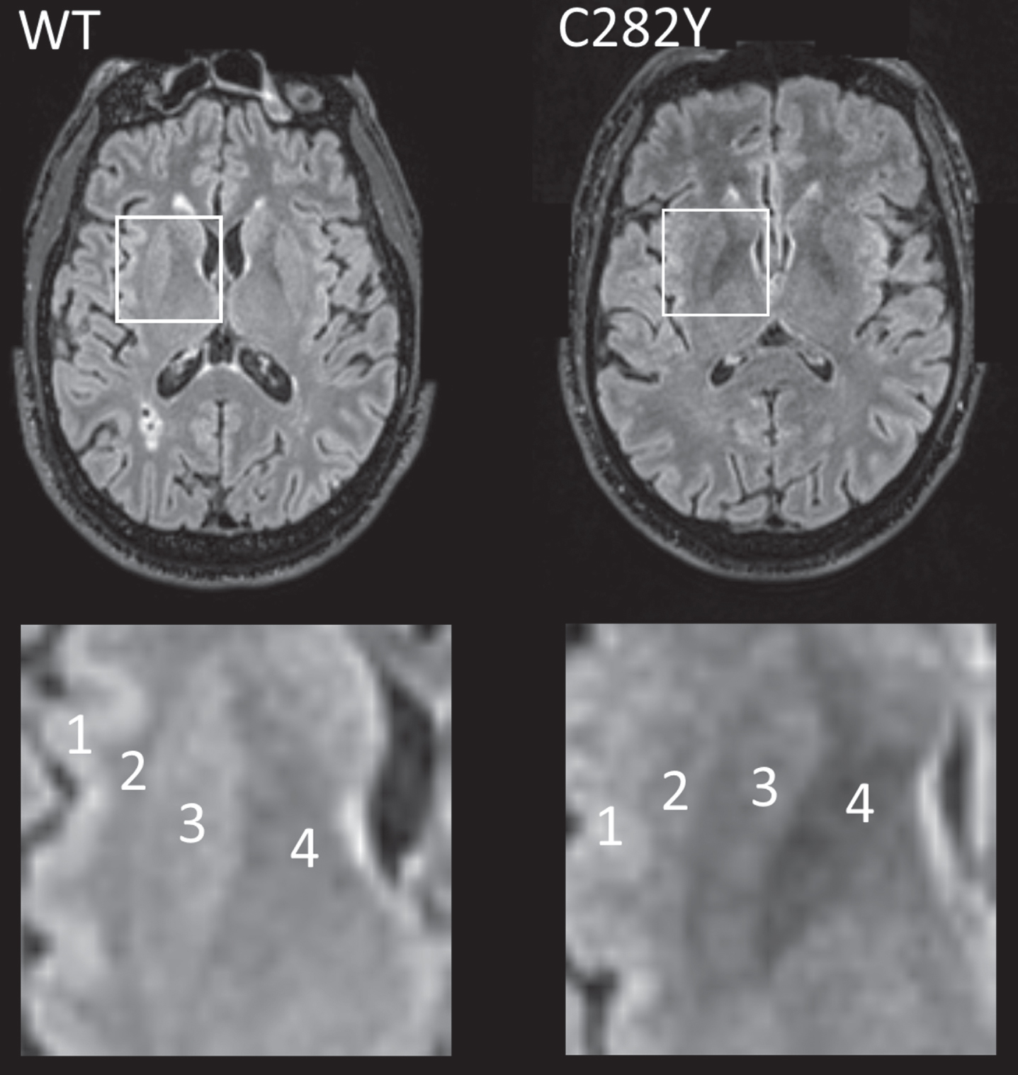
              MRI T2 FLAIR axial images for male participants closest to respective mean putamen T2* values with p.C282Y homozygote variants (right) and neither HFE variant (left, ‘WT’). In the highlighted square, cortical (1) and white matter (2) intensity appears similar in both images, but the p.C282Y homozygote image shows relative hypo-intensity (associated with iron deposition) in the putamen (3) and globus pallidus (4). Images provided by UK Biobank copyright under license. WT, wild type or neither p.C282Y nor p.H63D mutations present. See details of image acquisition in Supplementary Material.
            