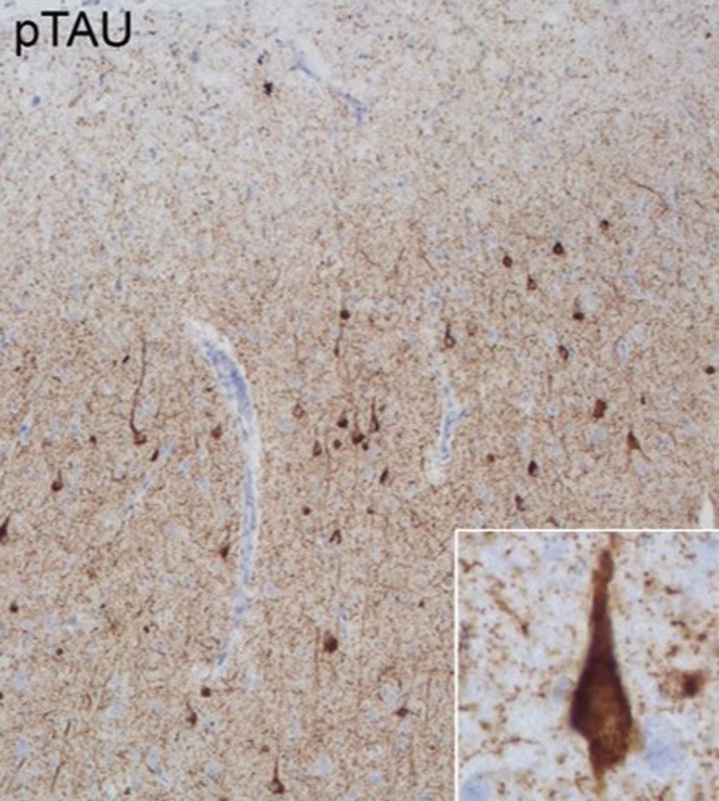 Pathological features of Case 3. Anterior cingulate cortex stained with phospho-tau (p-tau) monoclonal antibody (AT8: Pierce Biotechnology, Rockford, IL, USA). Extensive 3R and 4R tauopathy which is characteristic for MAPT related frontotemporal lobar degeneration is observed in neurons across all layers.