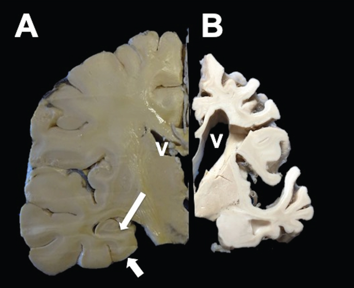 Coronal section of a healthy (left) and AD hemisphere (right). In AD, a considerable reduction in the brain volume with enlargement of the grooves between folds, prominent ventricles (V), and hippocampal atrophy (arrows) was observed.