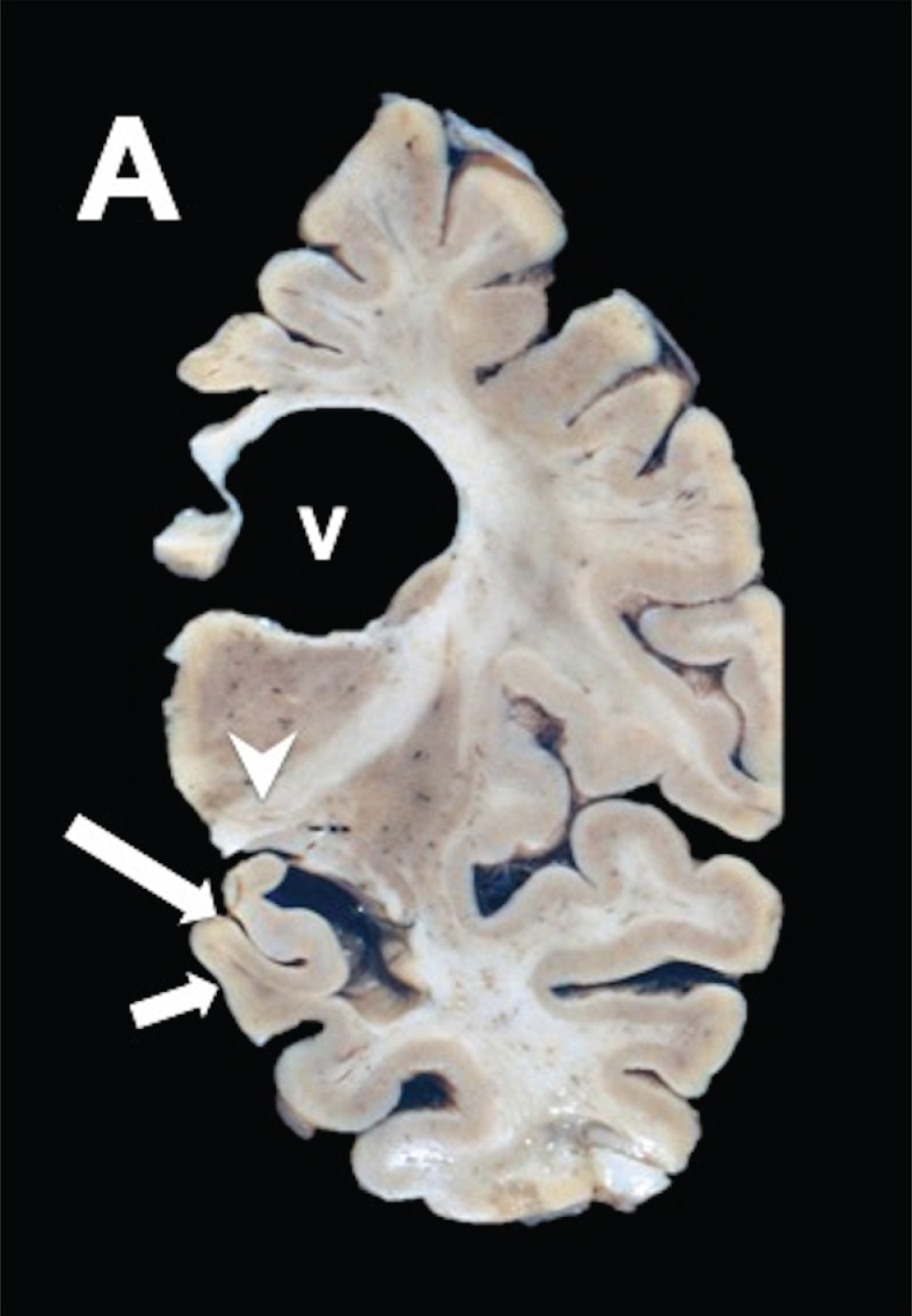 PSP coronal brain section of the brain stem shows discrete 
frontotemporal atrophy, quadrigeminal cistern atrophy, and sieve 
state in frontal periventricular white matter, and thalamus.
