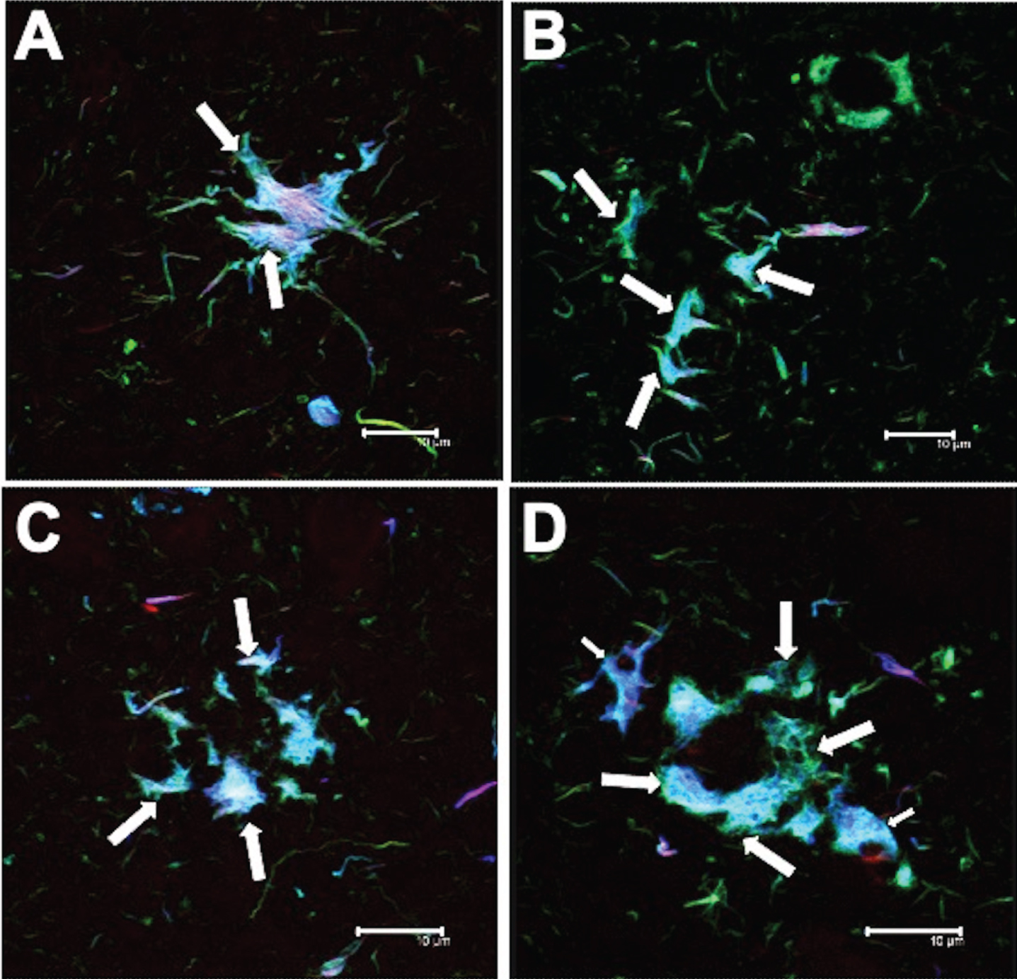 Different tau expression patterns in tufted astrocytes (TAs) in PSP. TAs were strongly recognized by AT8 and pS396 and colocalized with TR.