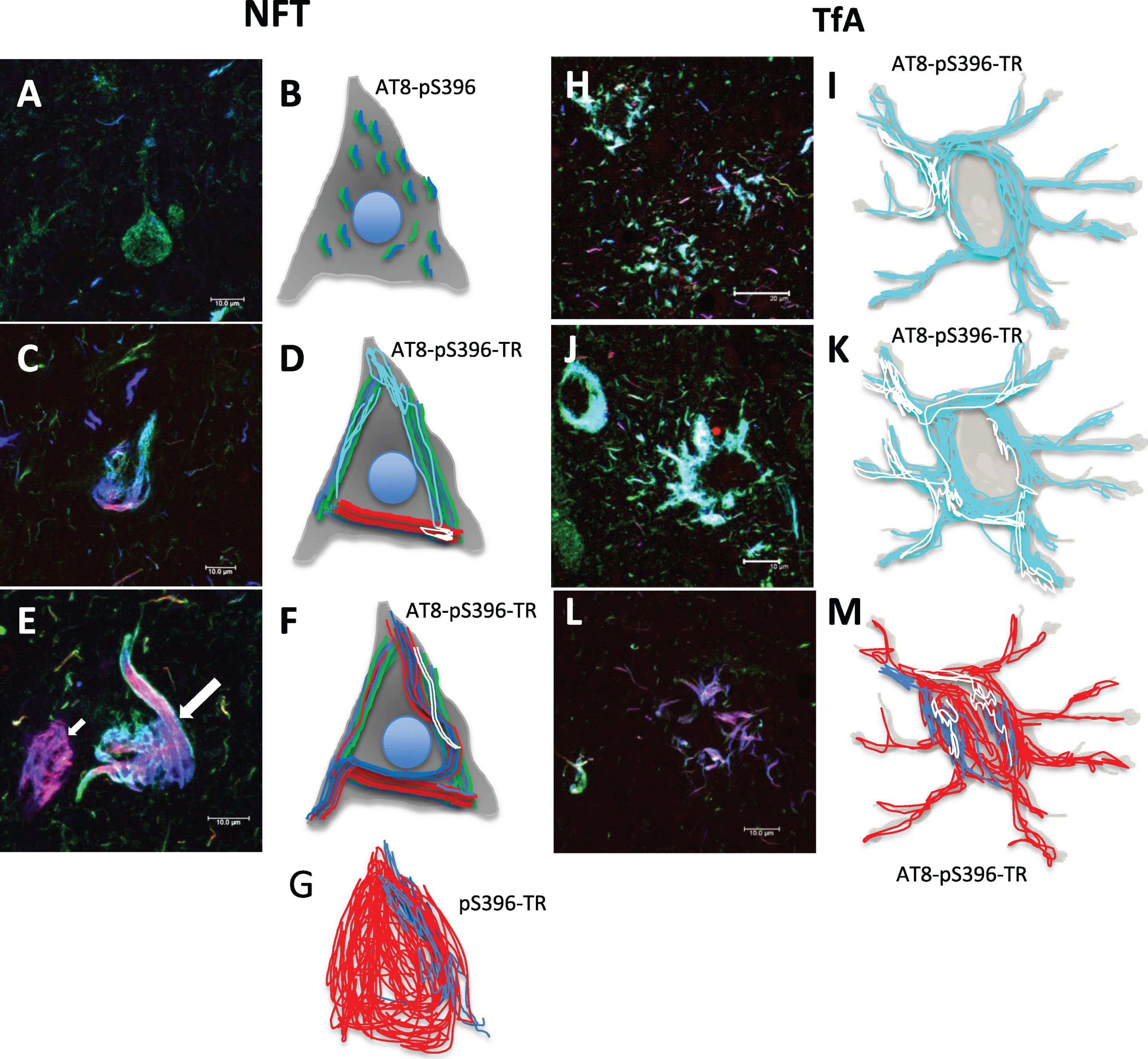 Schematic representation of the tau aggregation process in neuronal and glial degeneration in PSP. A-G) Neuronal degeneration, H-M) Glial degeneration. A) Neurofibrillary pre-tangle. B) Representation showing a staining of small fibrils positive to the AT8 and pS396 antibodies and distributed throughout the neuronal soma. C, D, F. Arrow) Representation of different tau aggregation events, positive for TR and colocalizing to varying degrees with AT8 and pS396 antibodies. E, G) NFT populations were recognized by TR and partially by the pS396 antibody. H, I, J, K) Tau aggregation pattern in glial cells, which colocalize to varying extents for AT8 and pS396 antibodies. L, M) Glial cells were mostly TR-positive. Scale bars, 100 μm.