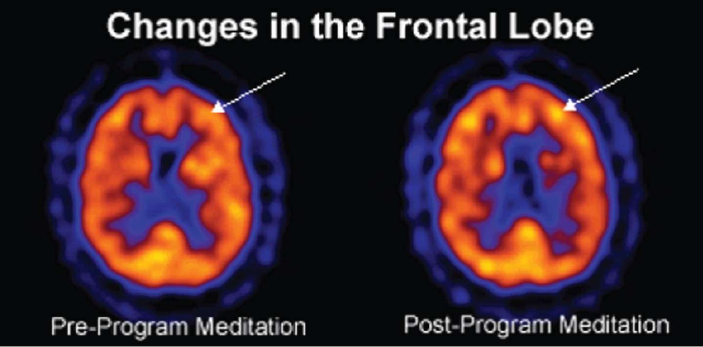 Changes in the frontal lobe.