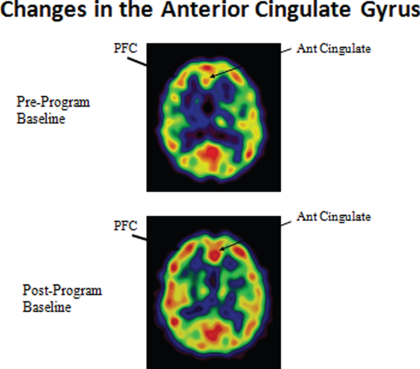 Enhanced cerebral blood flow in the prefrontal cortex and anterior cingulate gyrus.
