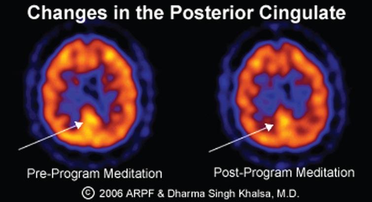 Changes in the posterior cingulate gyrus.